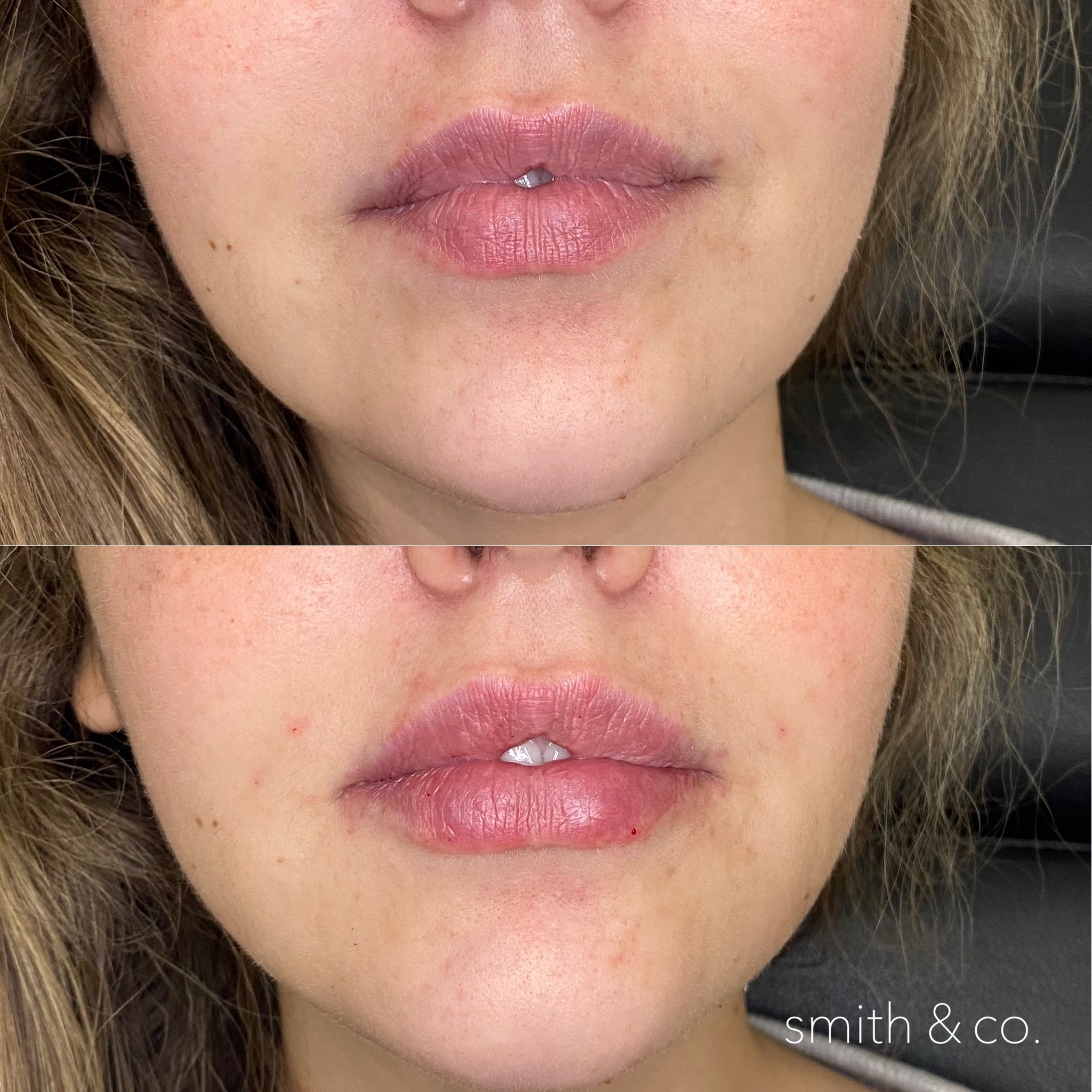 smith & co best botox and filler in miami_2663.PNG