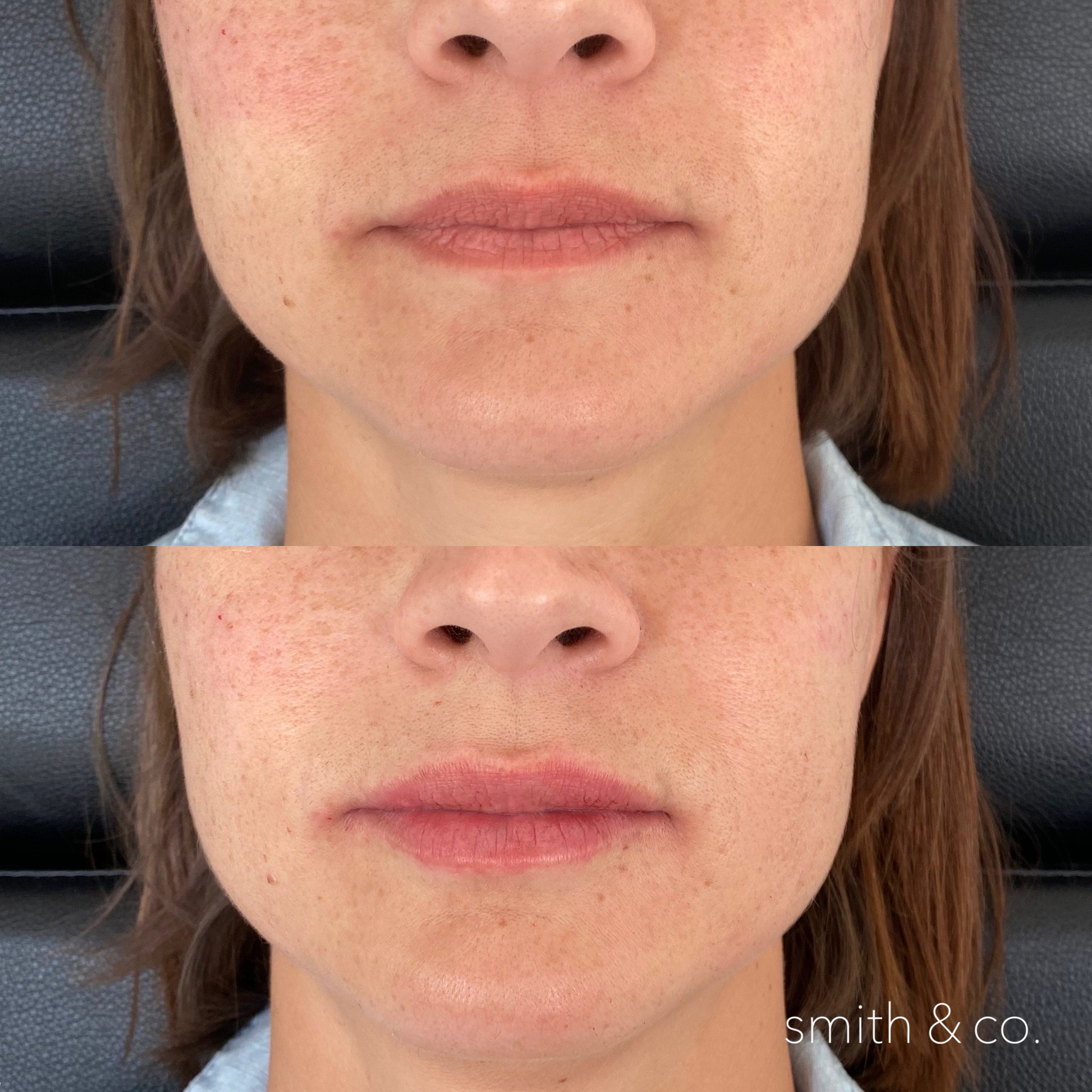 smith & co best botox and filler in miami_2665.PNG