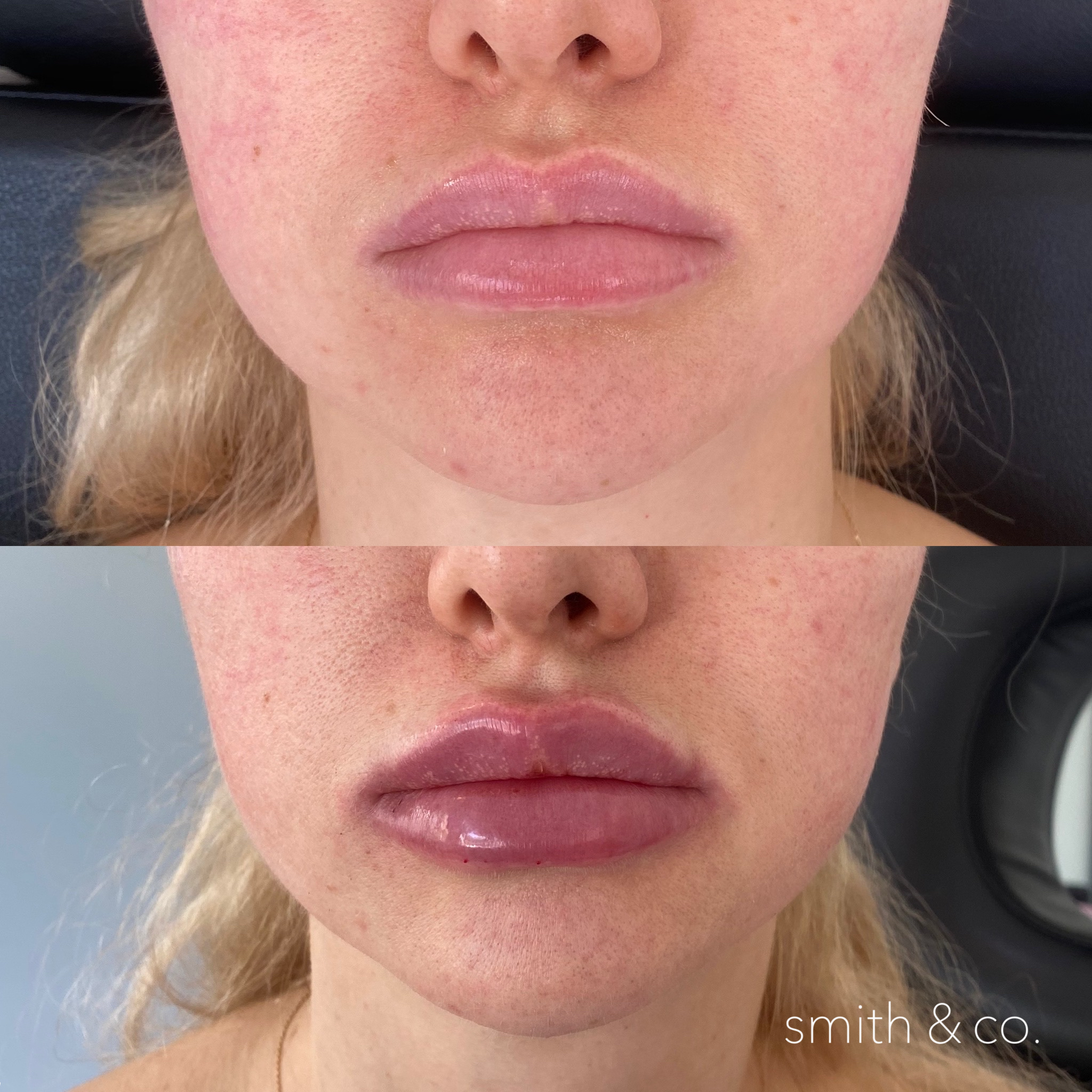 smith & co best botox and filler in miami_2669.PNG