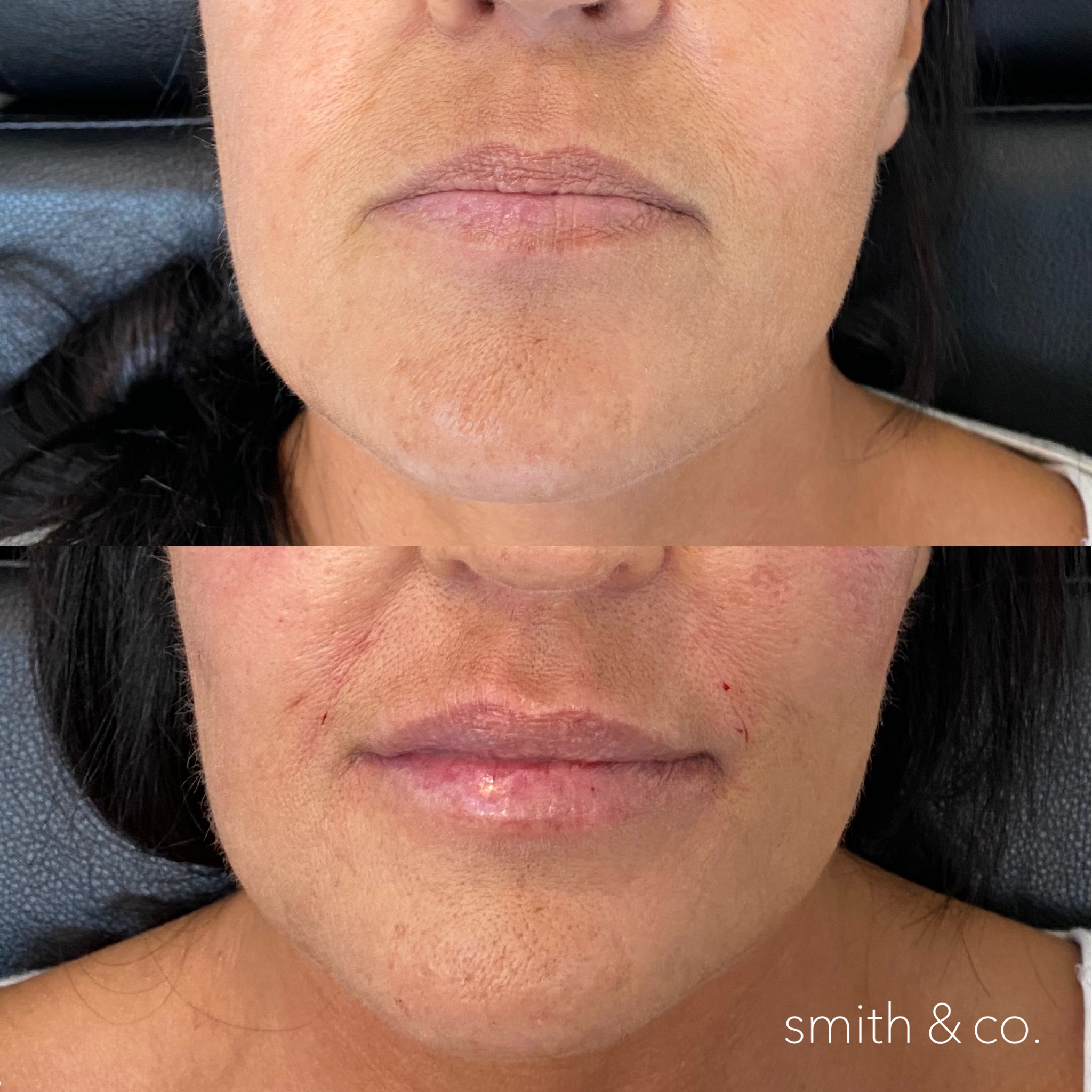 smith & co best botox and filler in miami_2675.PNG