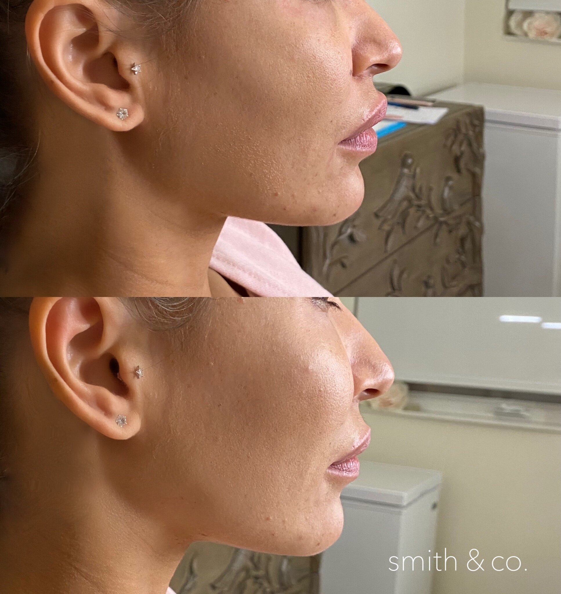 jawline contour with filler