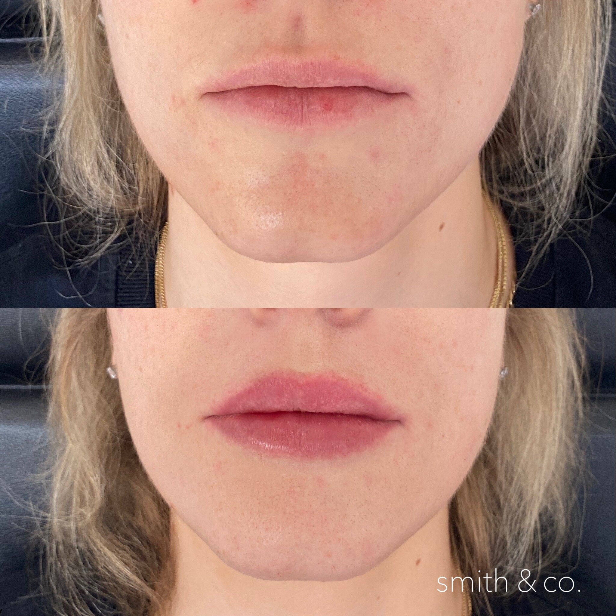 smith & co best lip fillers and PDO threads in miami_2550.JPG