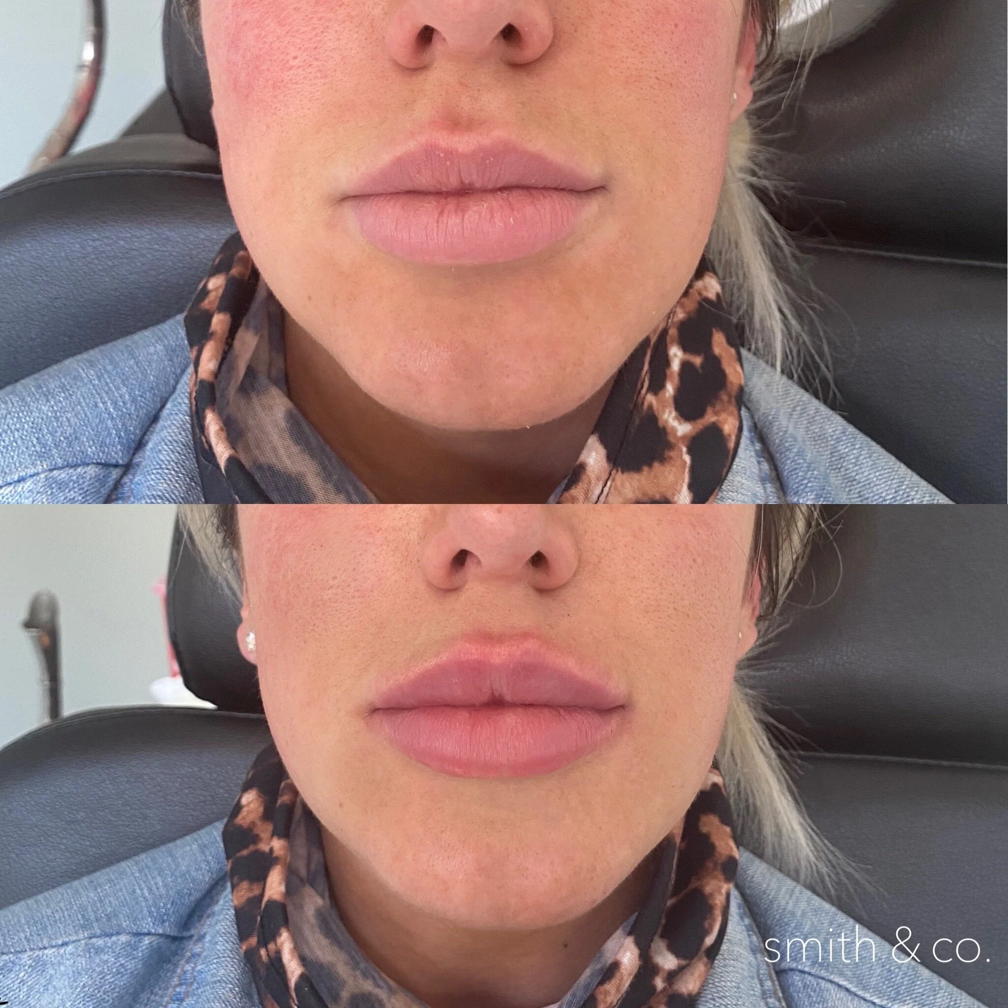 smith & co best lip fillers and PDO threads in miami_3845.JPG