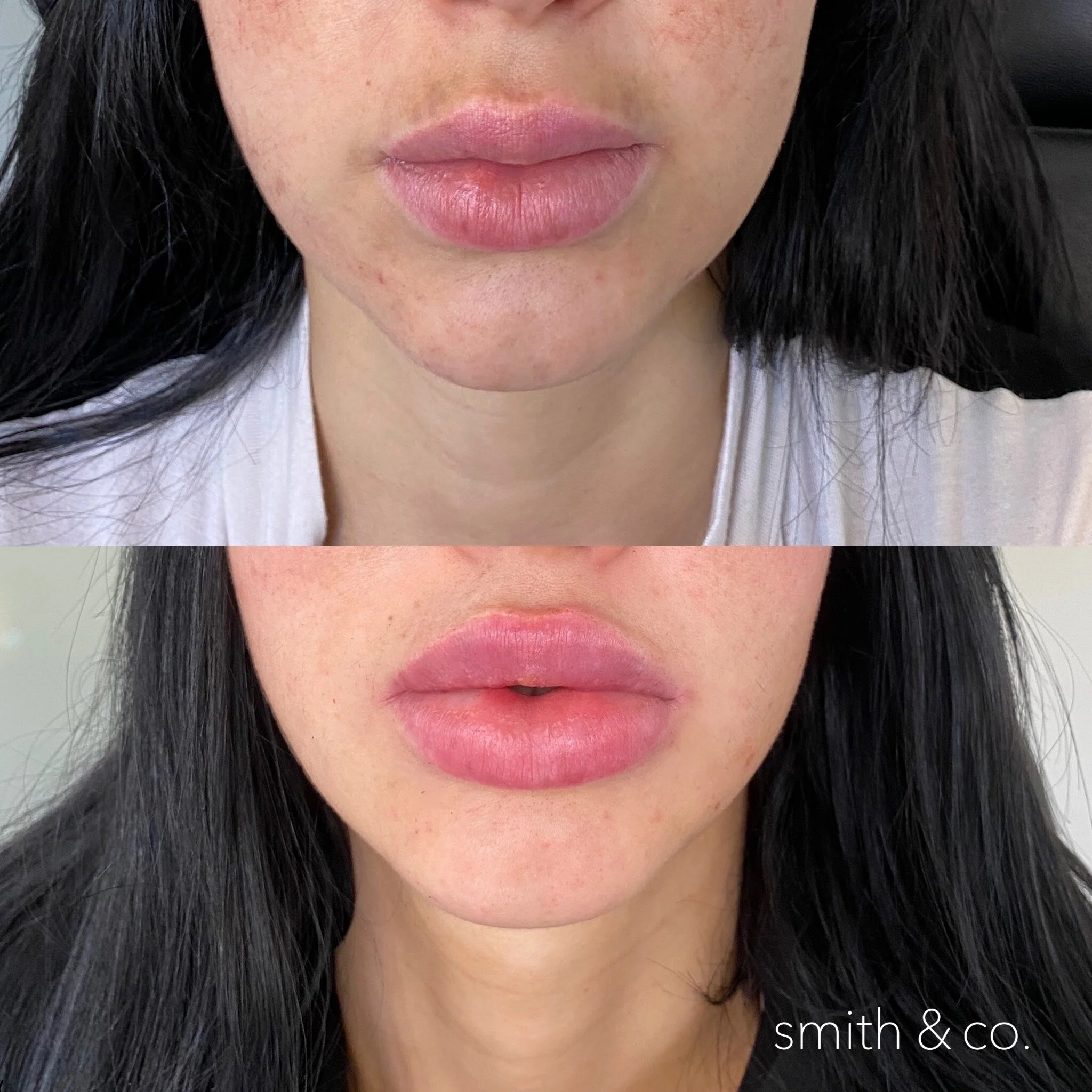 smith & co best lip fillers and PDO threads in miami_2540.JPG