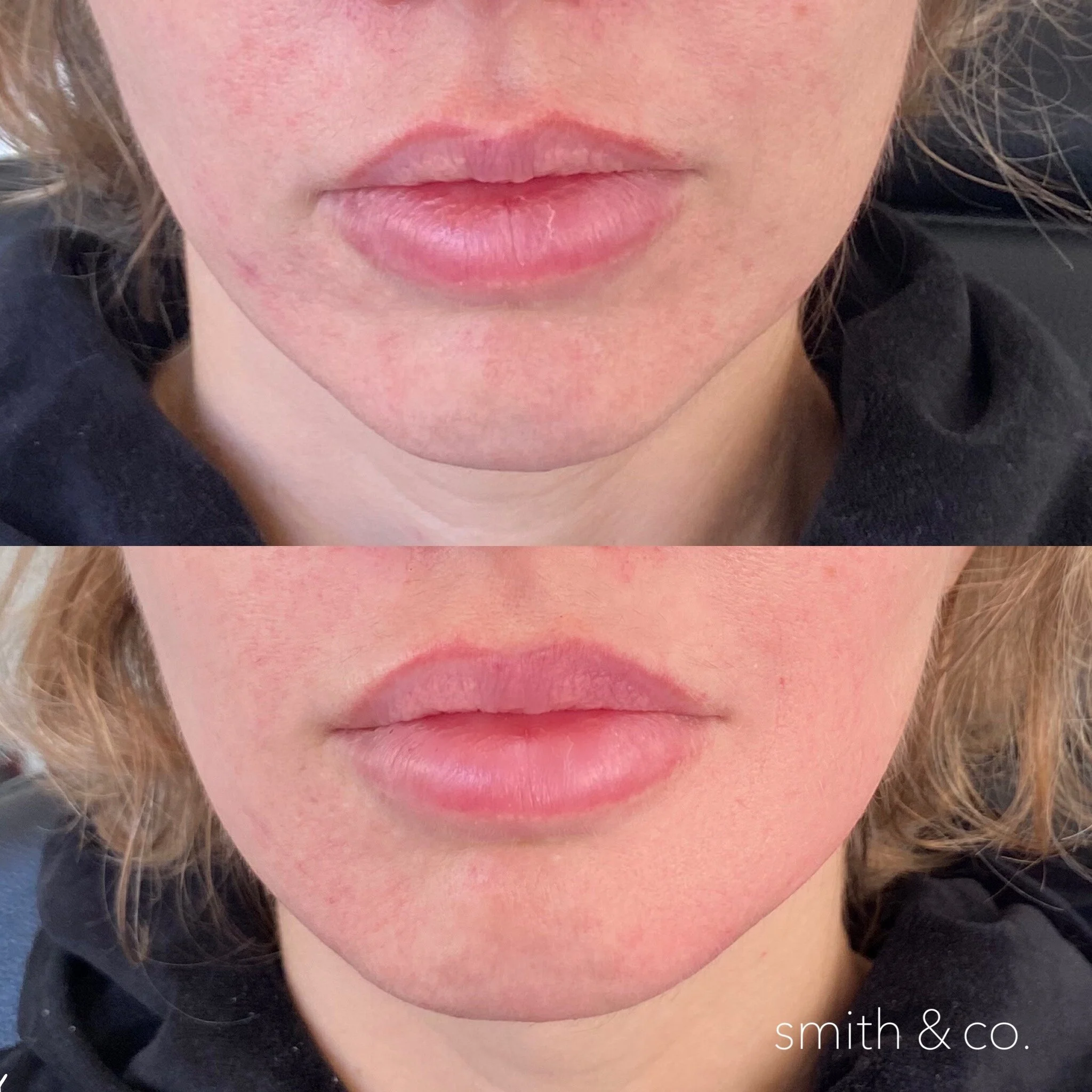 smith & co best lip fillers and PDO threads in miami_1027.JPG