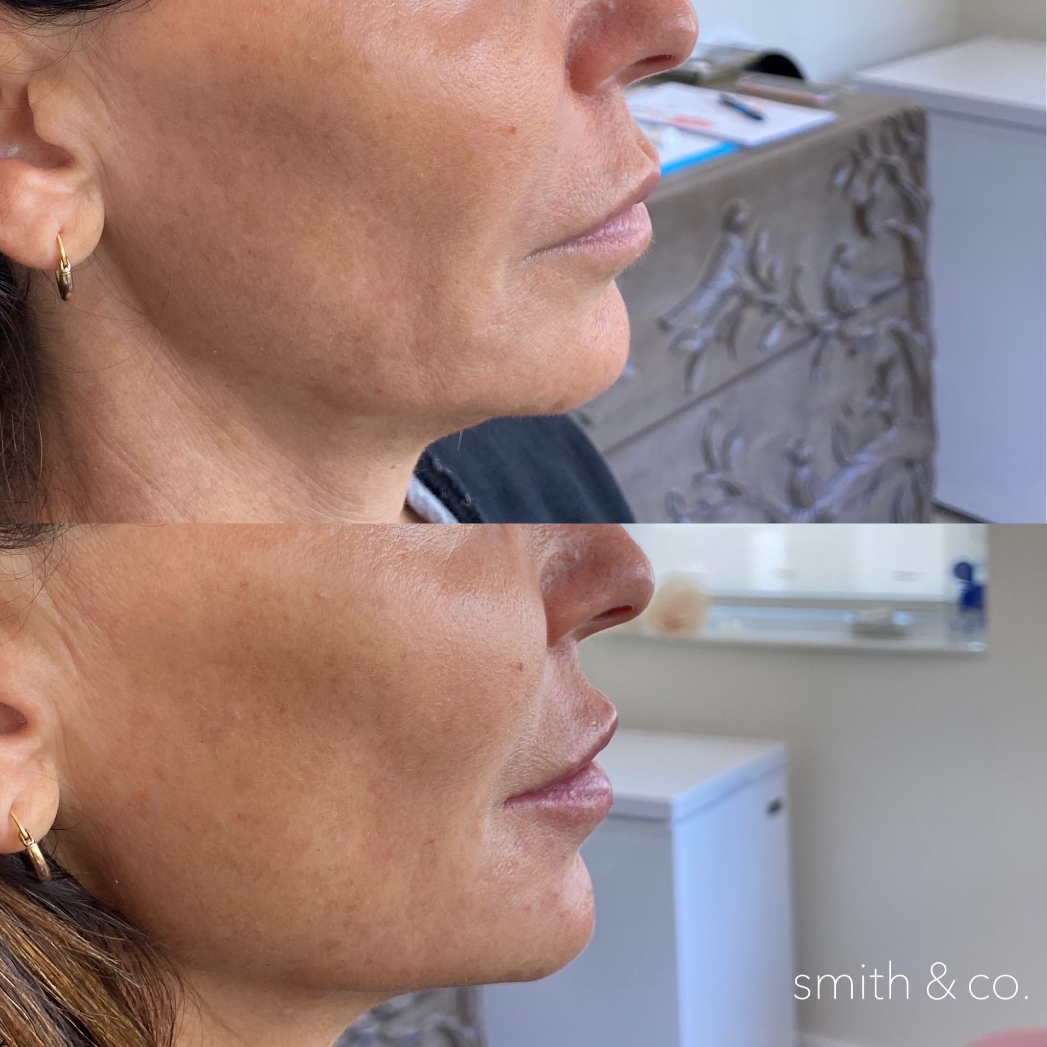smith & co best lip fillers and PDO threads in miami_5480.PNG