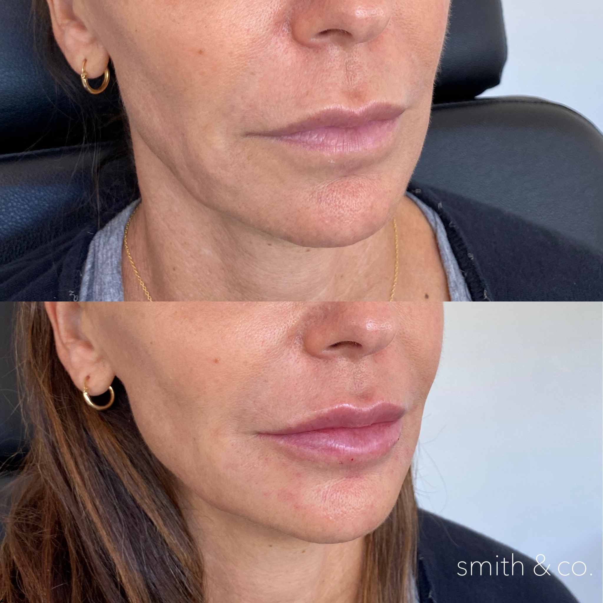 smith & co best lip fillers and PDO threads in miami_5486.PNG