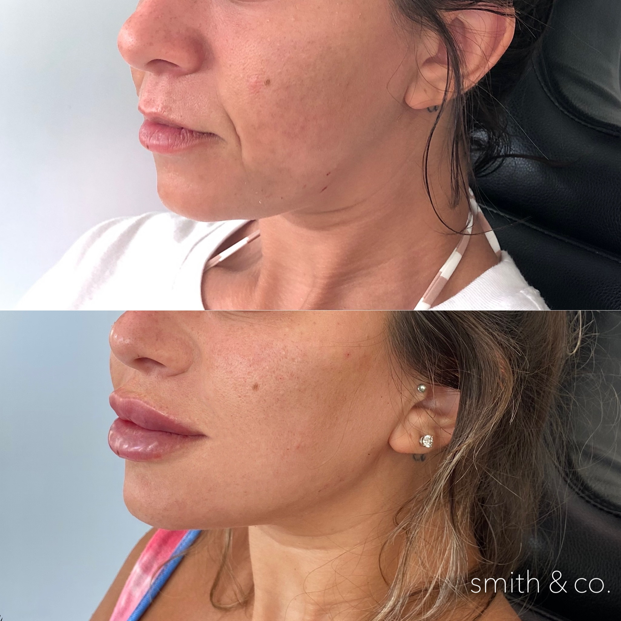 cheek and jawline contour with filler with nasolabial fold filler