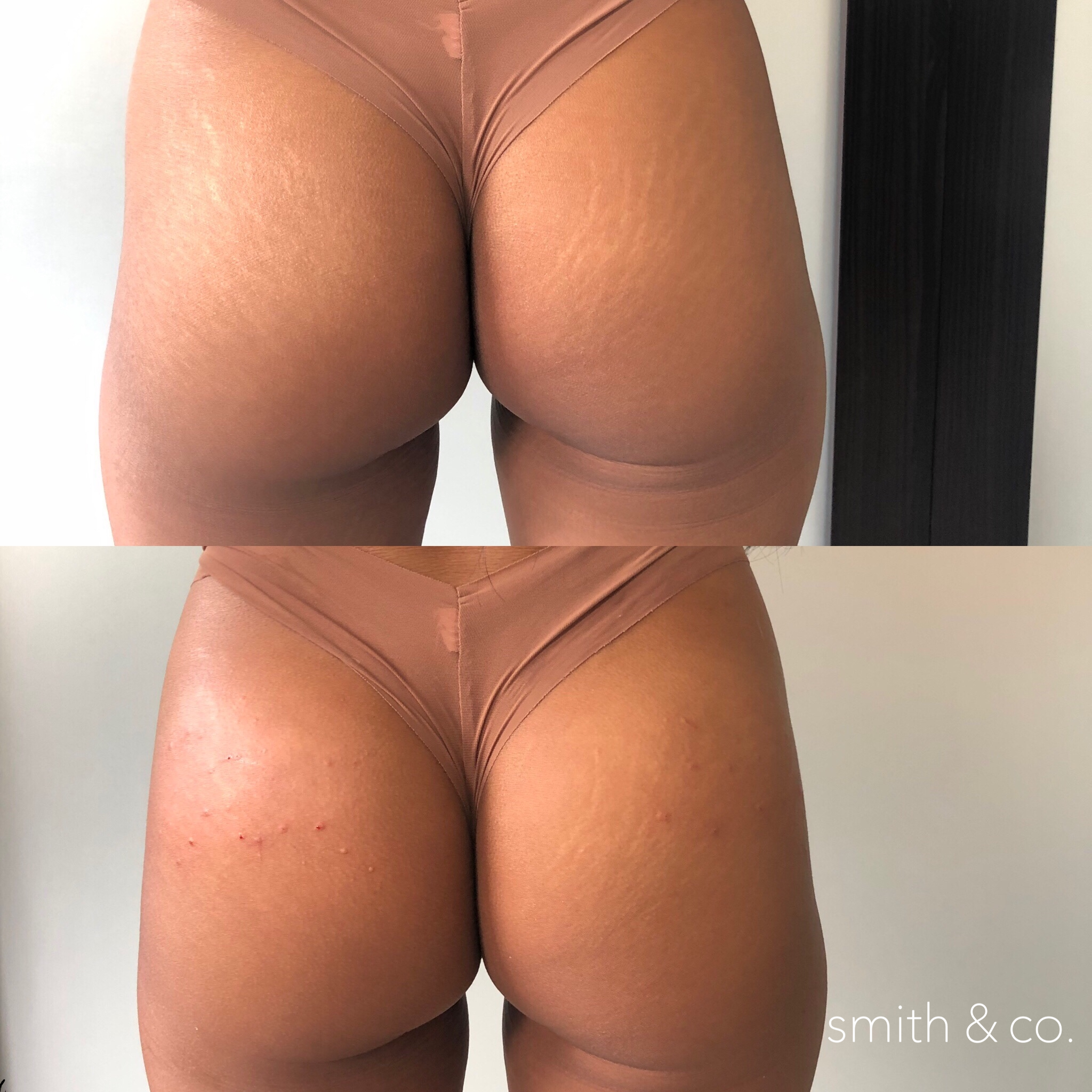 Sculptra butt injections miami.PNG