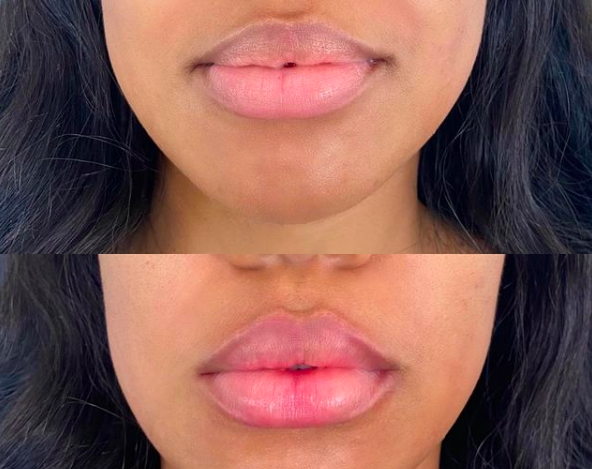 ✨ how to get rid of a bruised lip from kissing