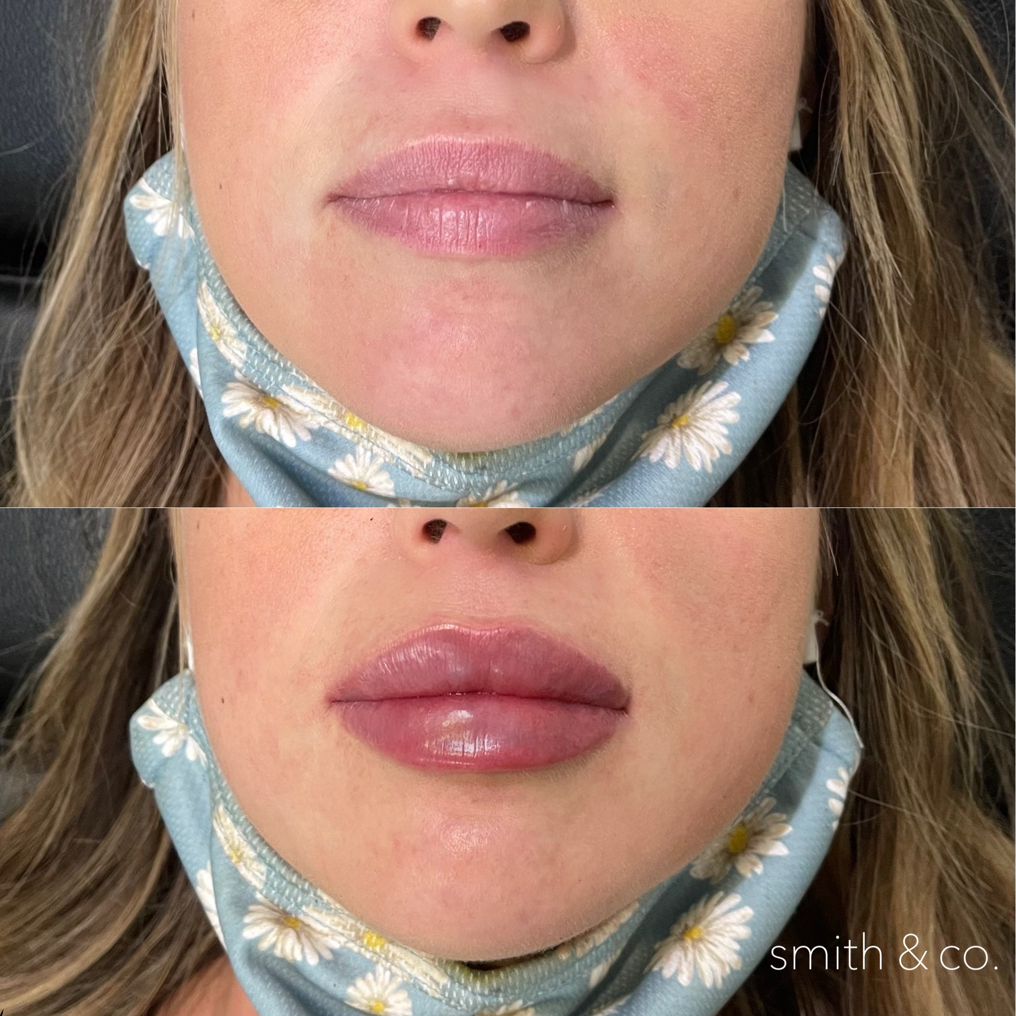 smith & co best lip fillers and PDO threads in miami, ashton technique, russian technique_6237.PNG