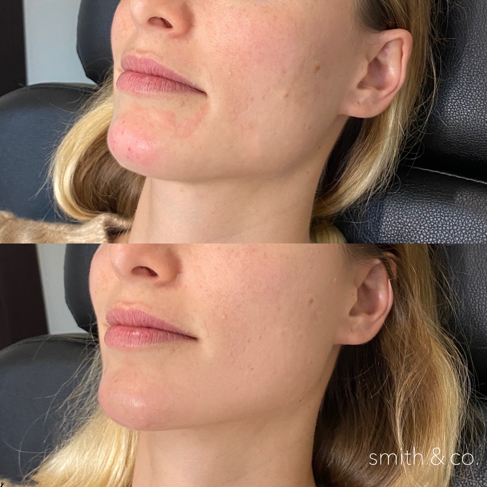 jawline contour with filler