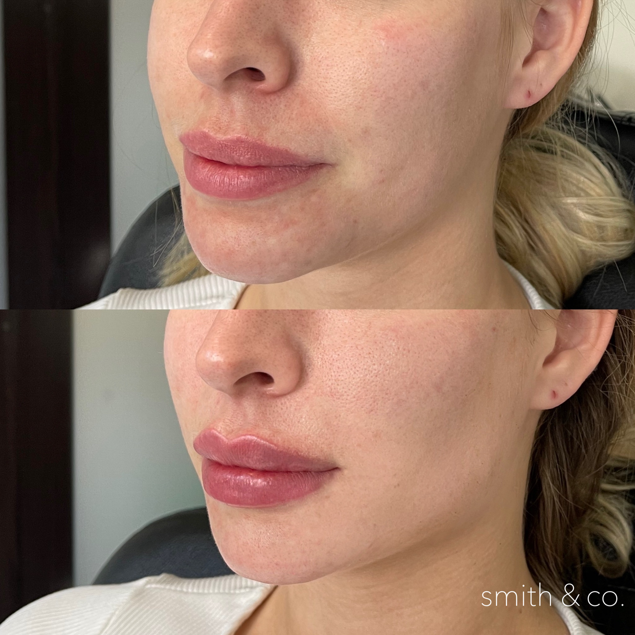 lips and jawline contour with filler