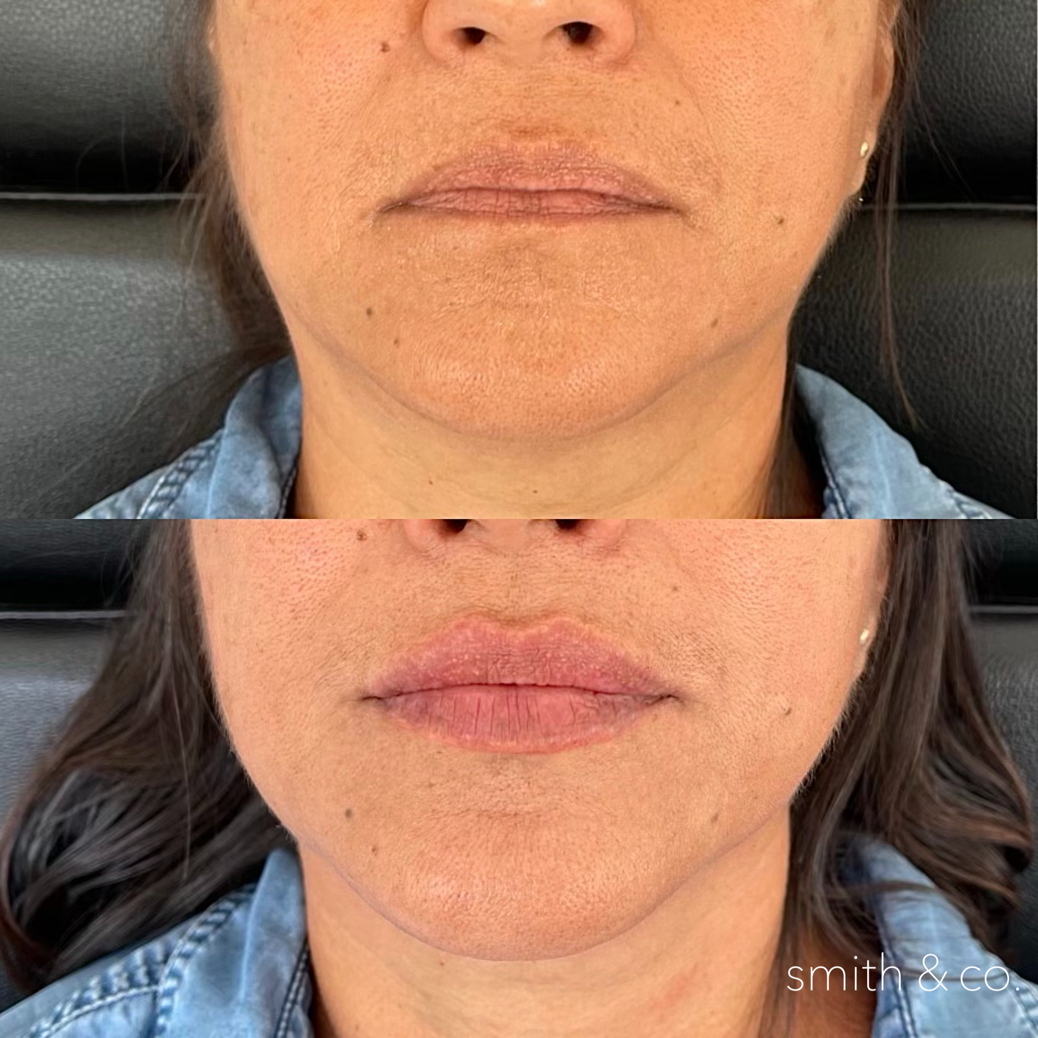 smith & co best lip fillers and PDO threads in miami, ashton technique, russian technique_2578.PNG