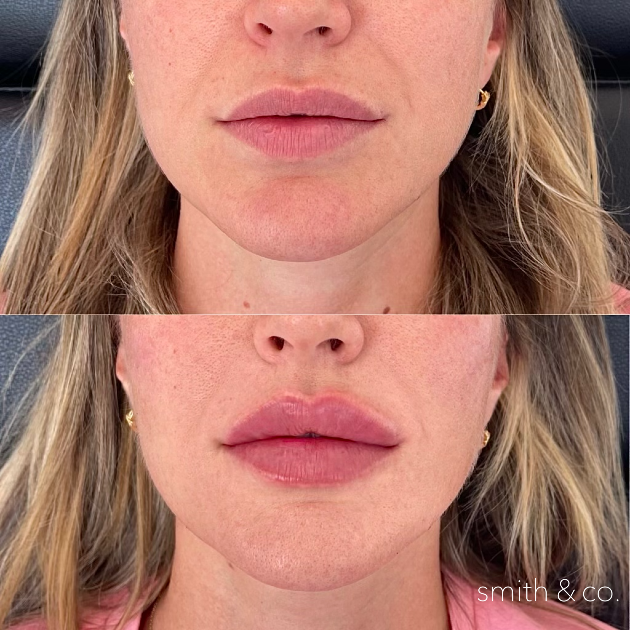 smith & co best lip fillers and PDO threads in miami, ashton technique, russian technique_2597.PNG