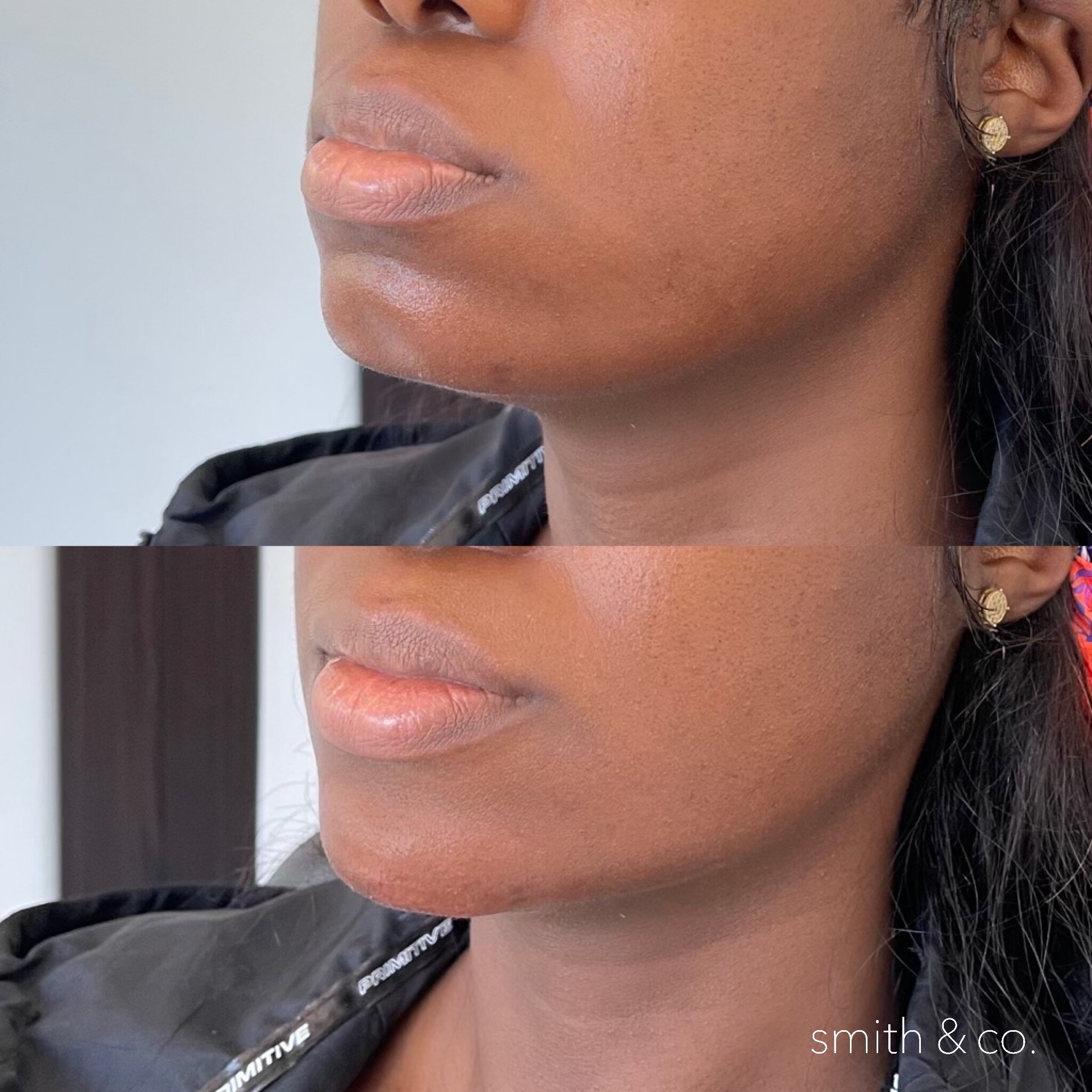 jawline contour with filler