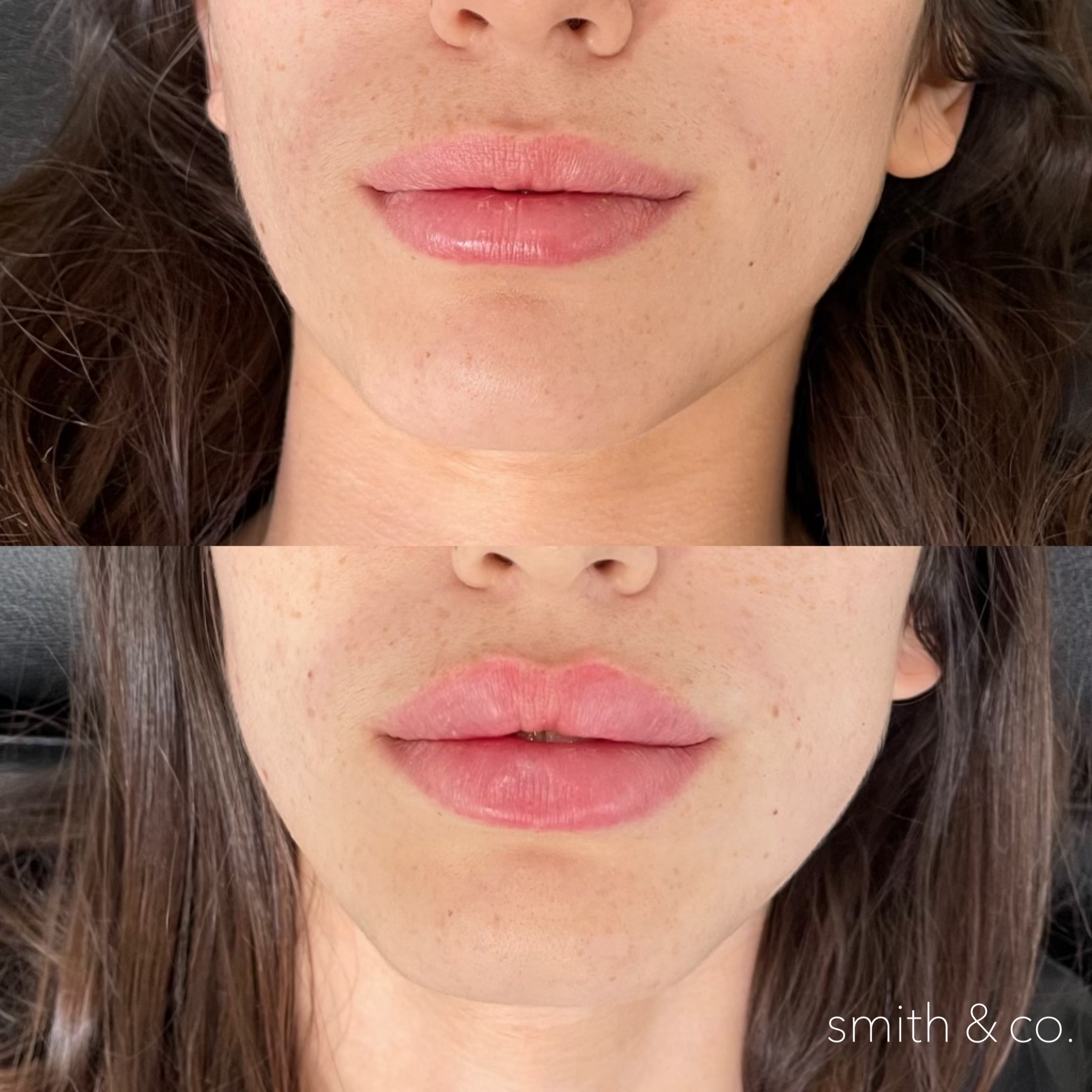 smith & co best lip fillers and PDO threads in miami, ashton technique, russian technique_9233.PNG