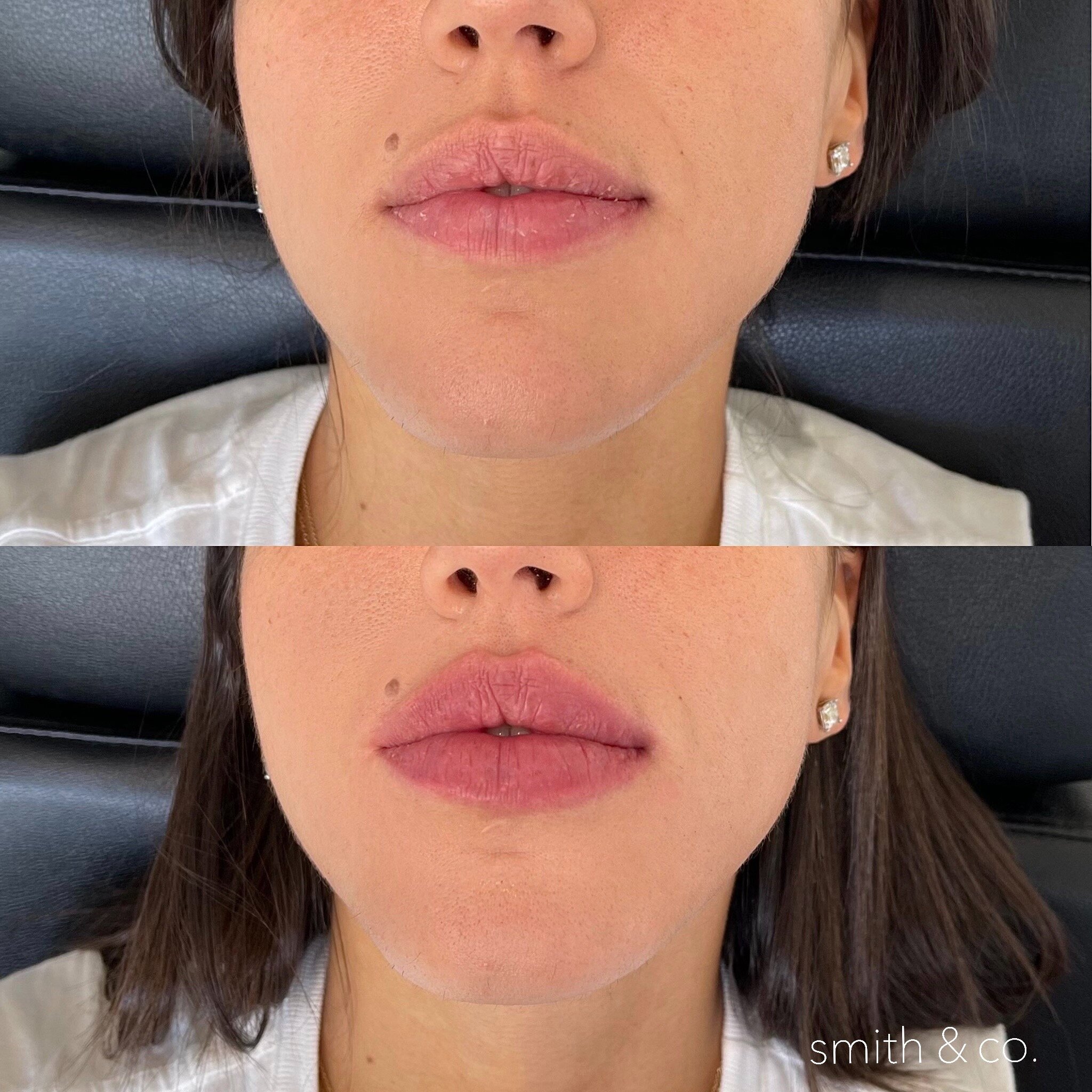 lip images — Miami Beach Botox Specialist