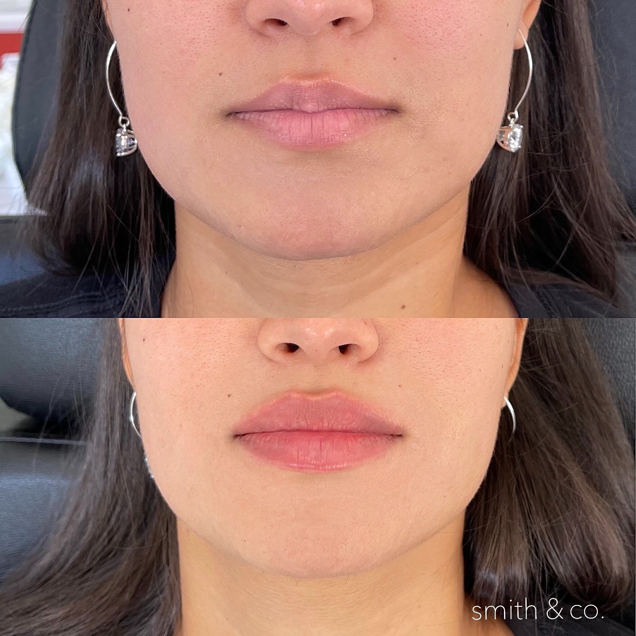 smith & co best lip fillers and PDO threads in miami, ashton technique, russian technique_4384.JPG