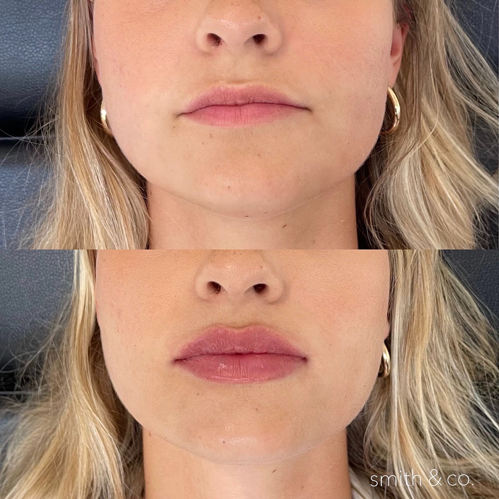 smith & co best lip fillers and PDO threads in miami, ashton technique, russian technique_4387.JPG