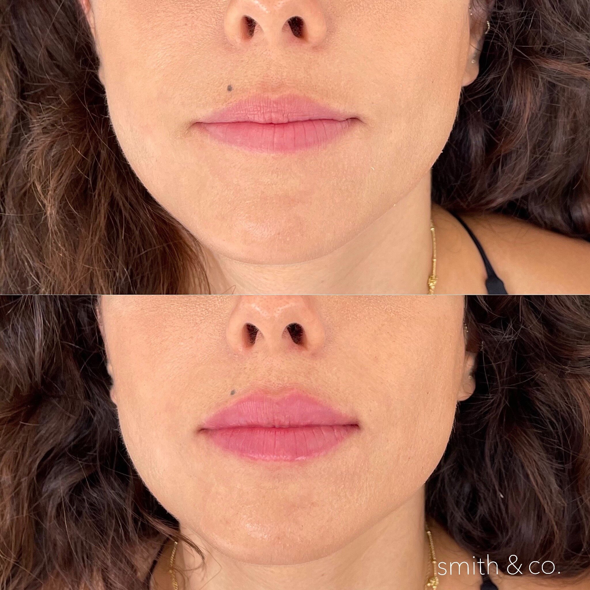 smith & co best lip fillers and PDO threads in miami, ashton technique, russian technique_4452.JPG