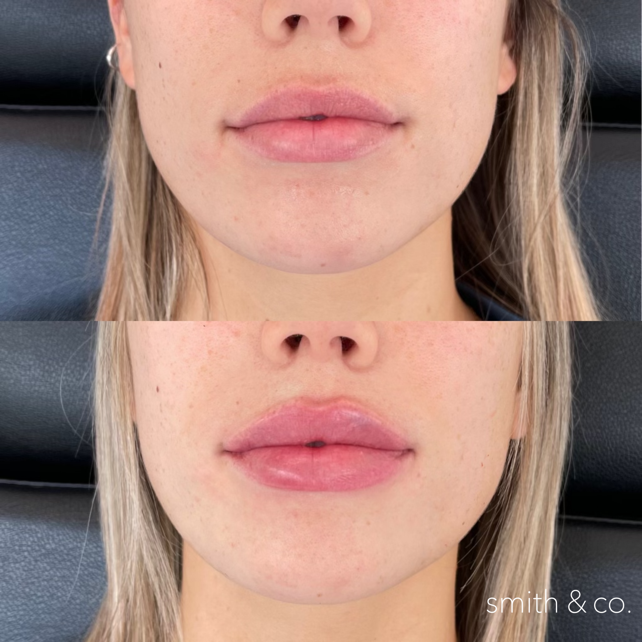 smith & co best lip fillers and PDO threads in miami, ashton technique, russian technique_9223.PNG