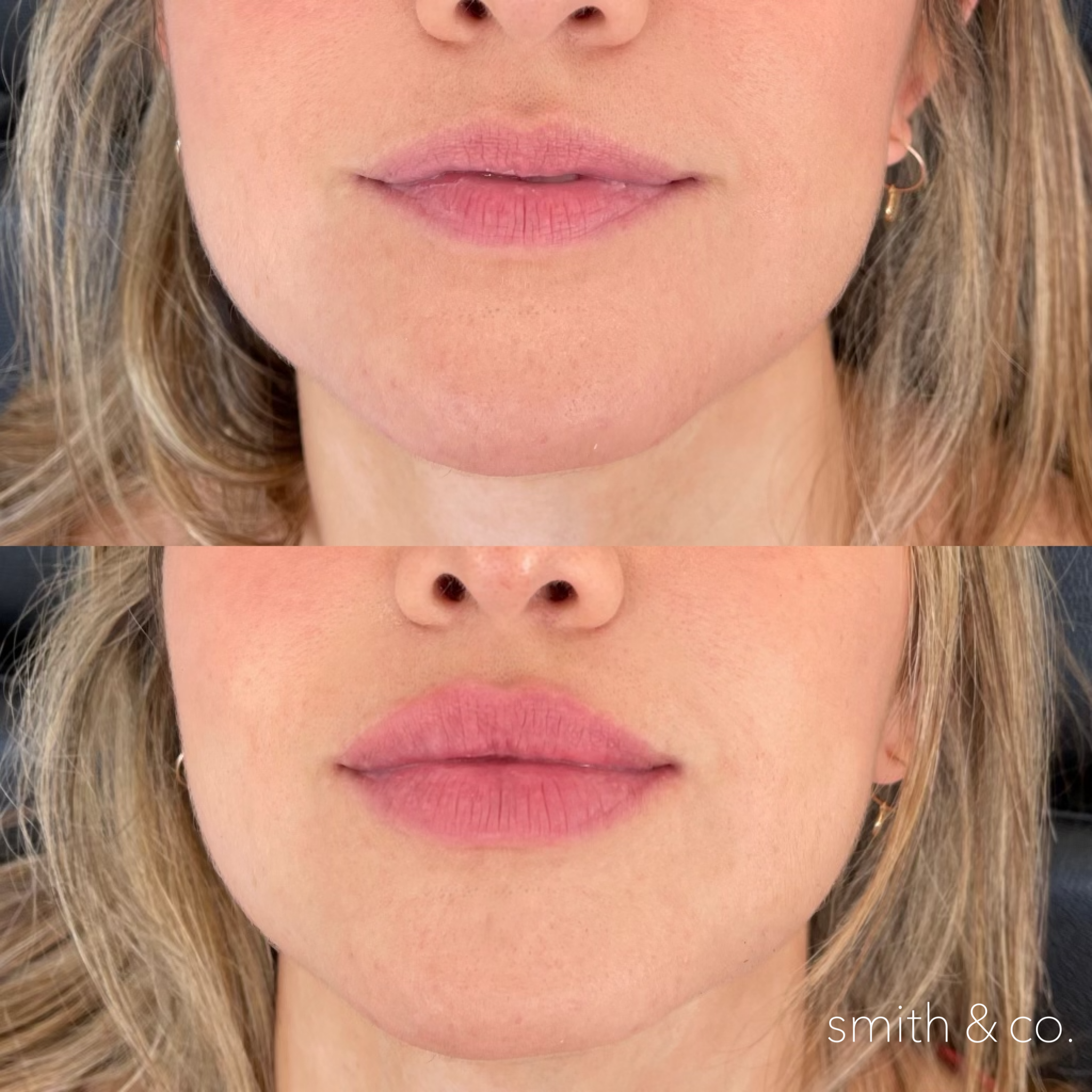 smith & co best lip fillers and PDO threads in miami, ashton technique, russian technique_9229.PNG