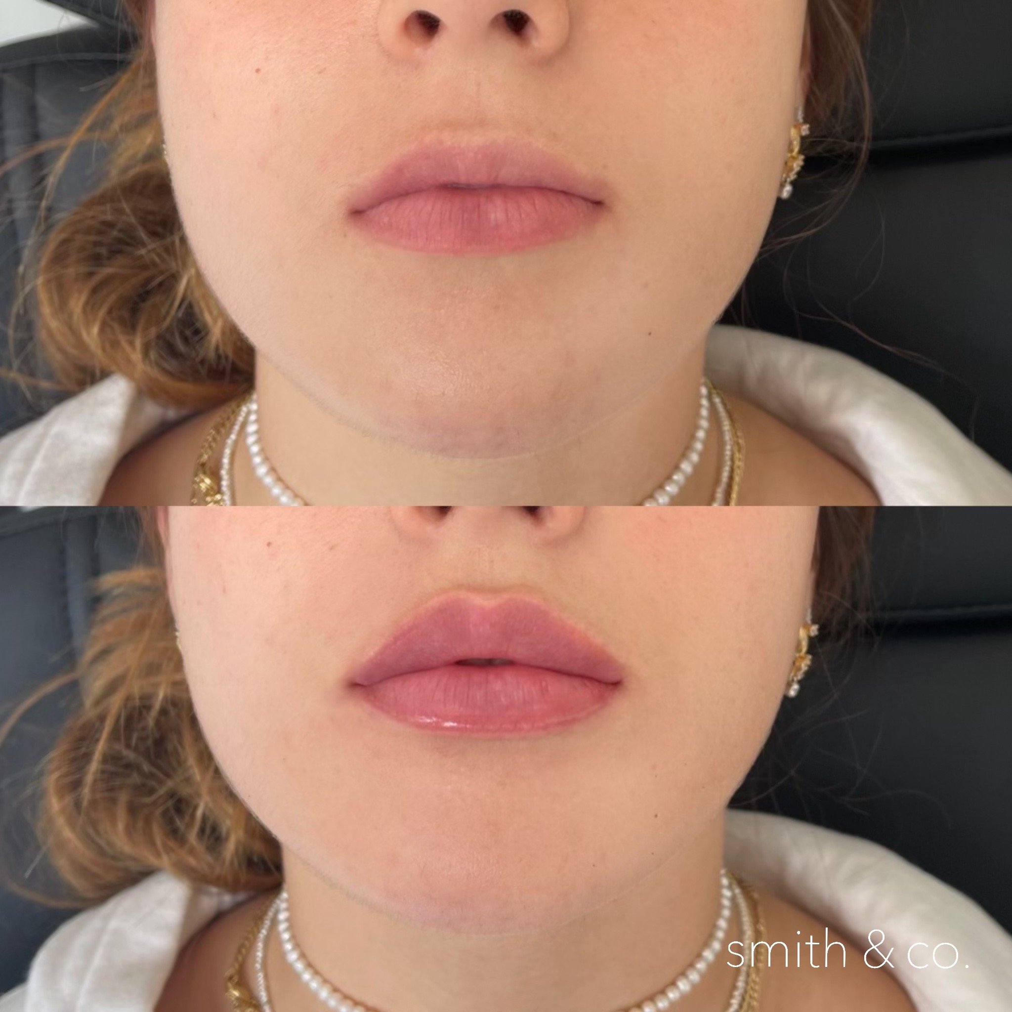 smith & co best lip fillers and PDO threads in miami, ashton technique, russian technique_0189.JPG