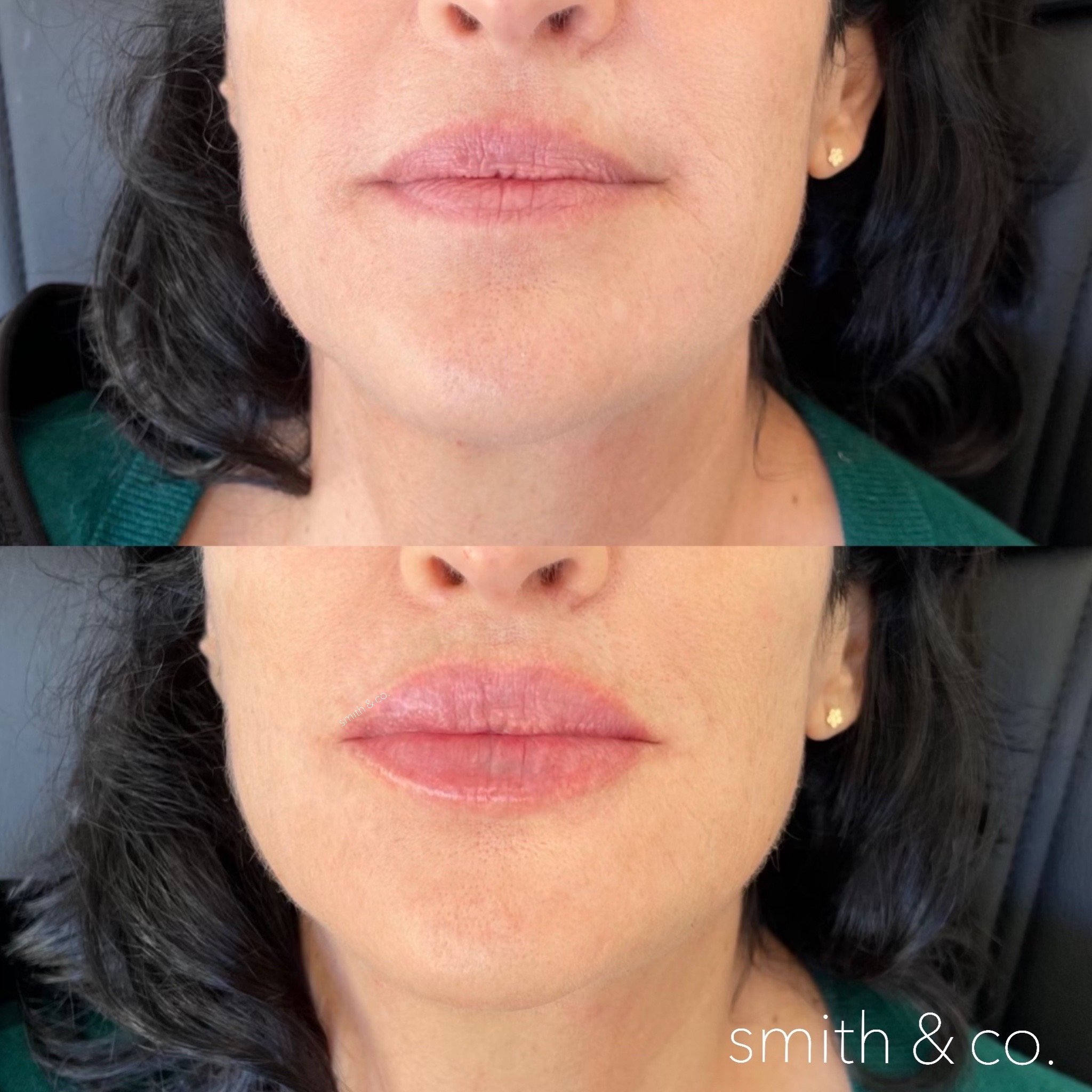 smith & co best lip fillers and PDO threads in miami, ashton technique, russian technique_0694.JPG