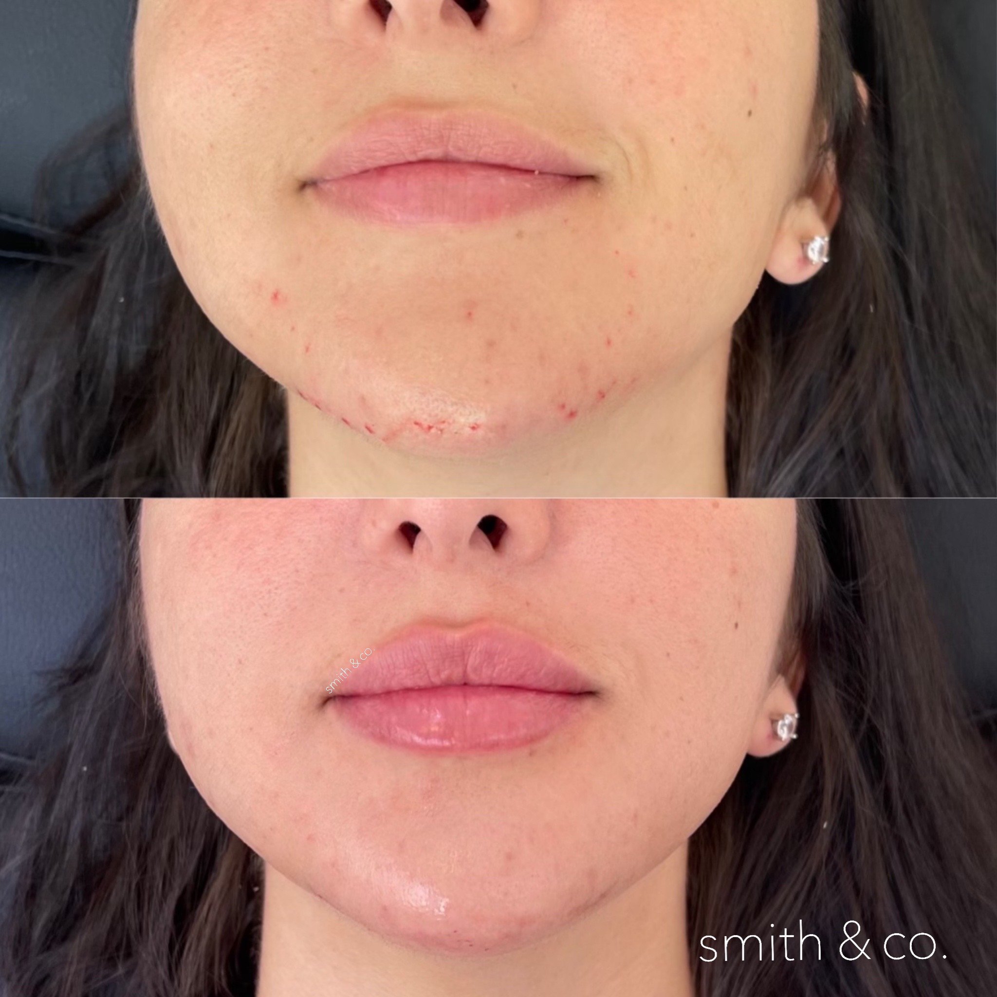 smith & co best lip fillers and PDO threads in miami, ashton technique, russian technique_1258.JPG