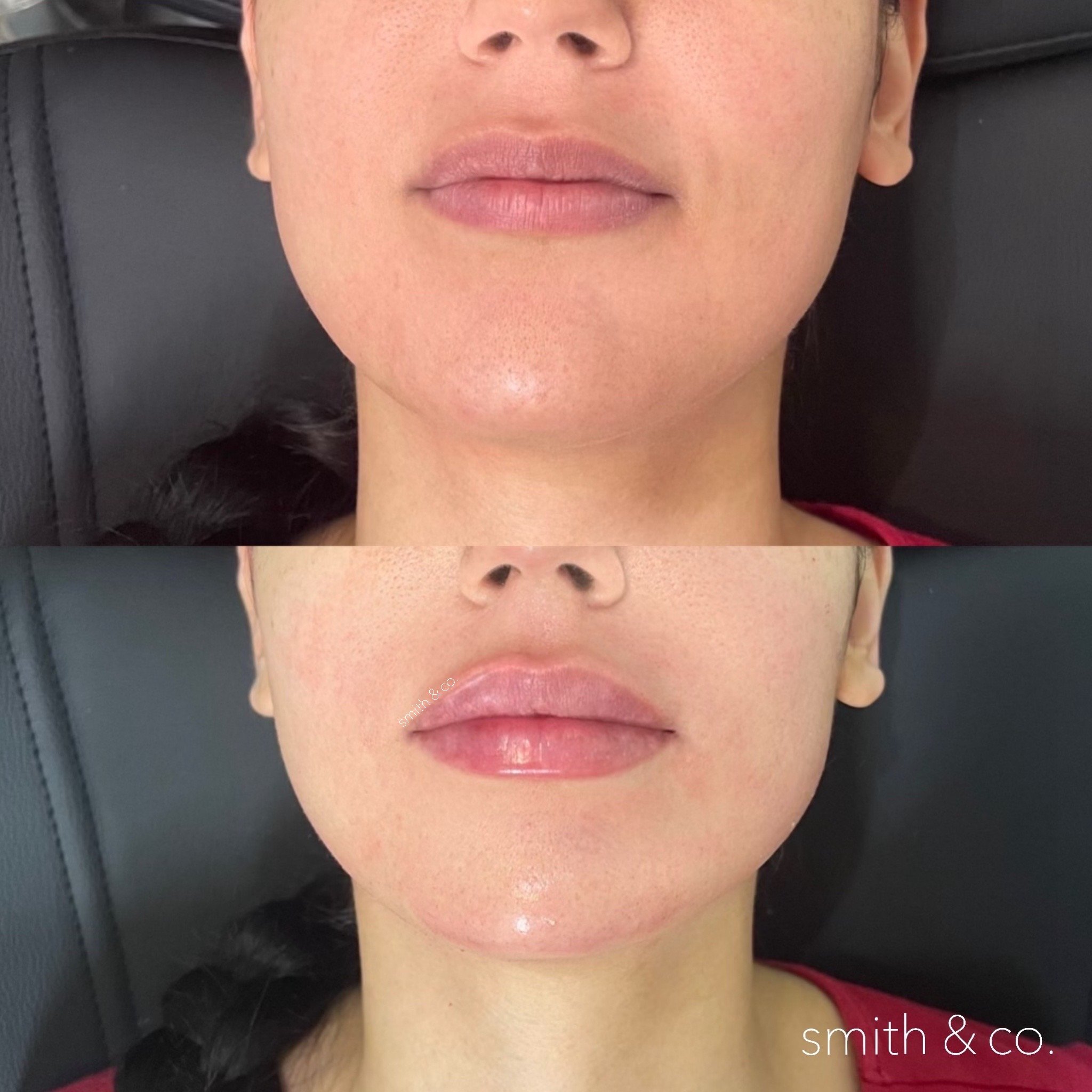 smith & co best lip fillers and PDO threads in miami, ashton technique, russian technique_2972.JPG
