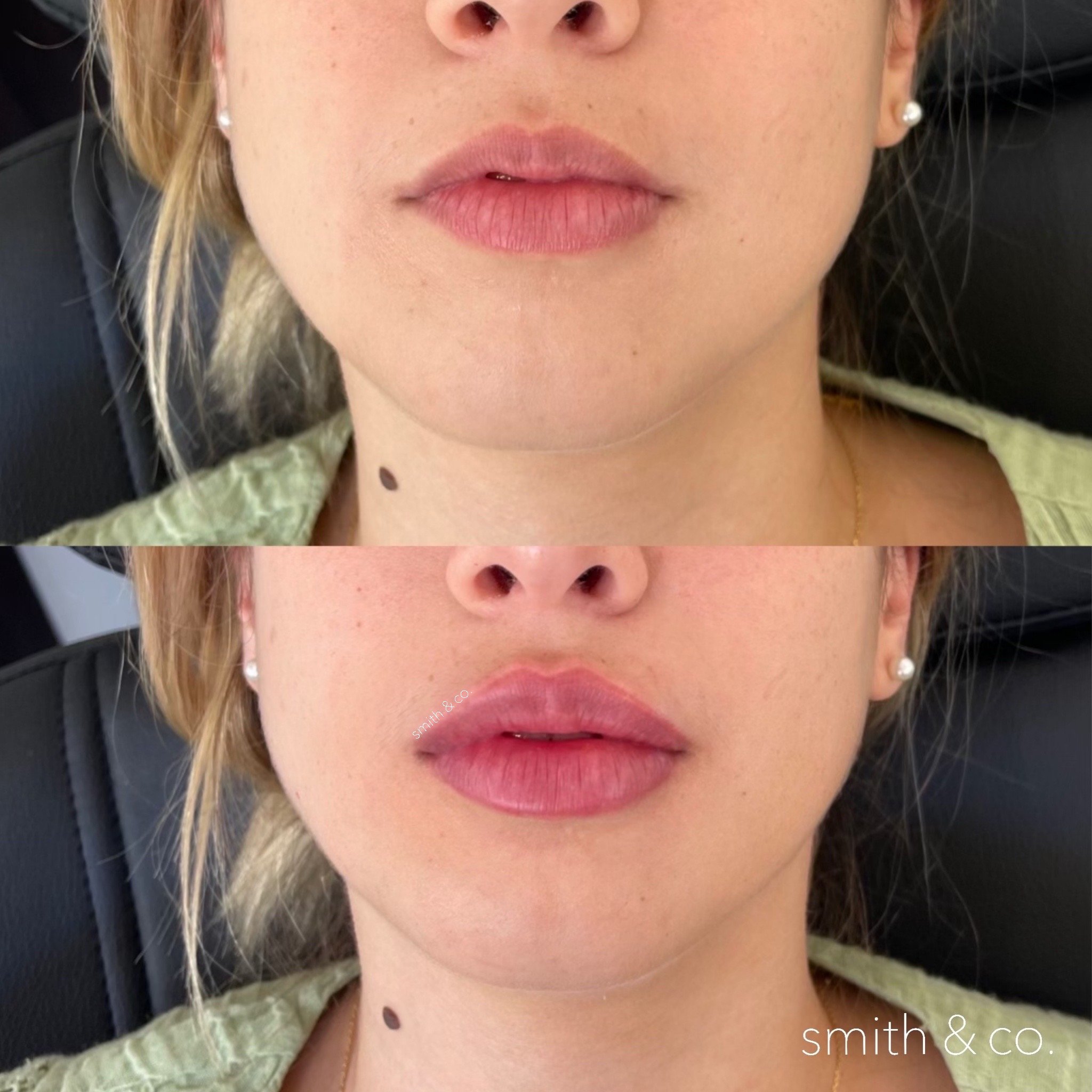 smith & co best lip fillers and PDO threads in miami, ashton technique, russian technique_2974.JPG