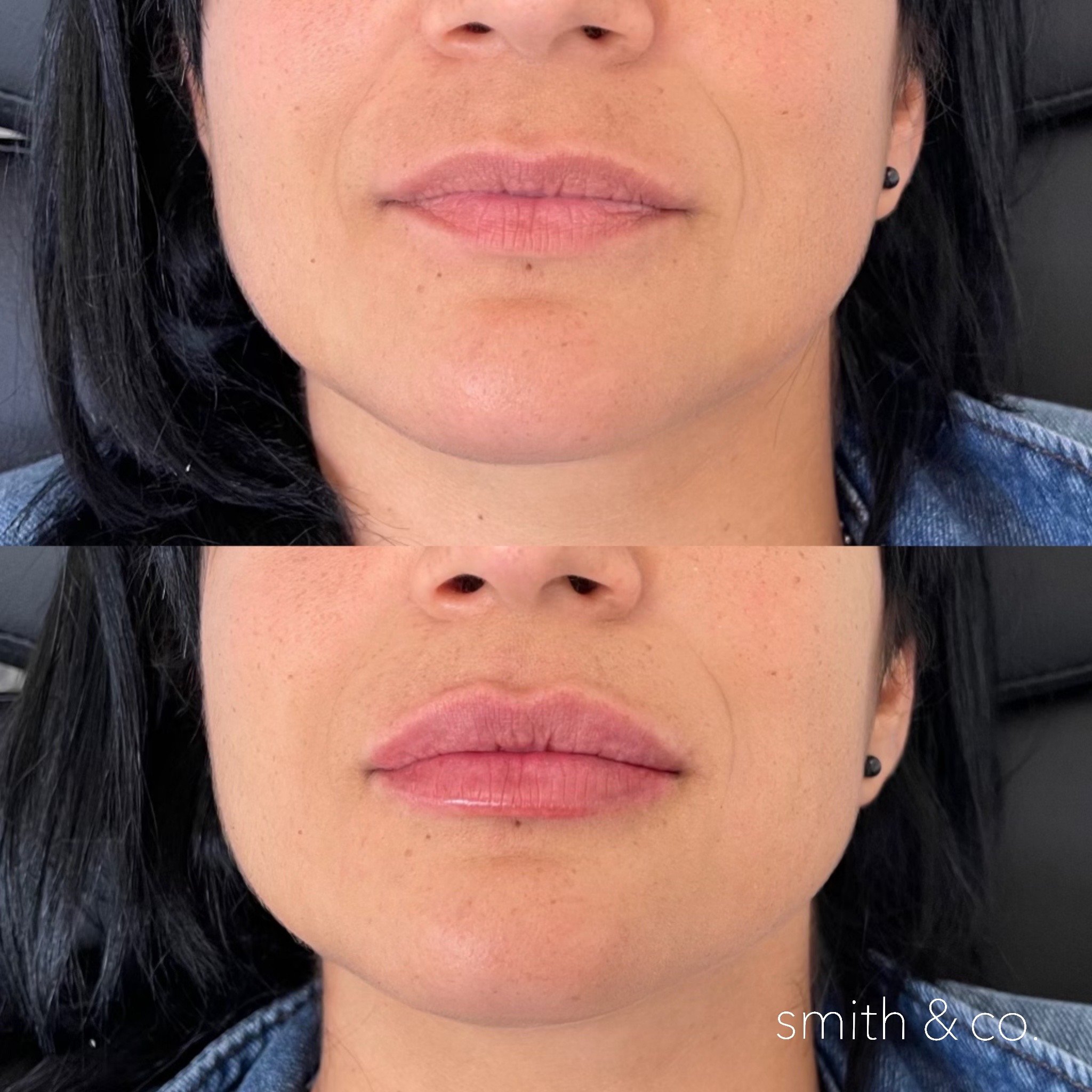 smith & co best lip fillers and PDO threads in miami, ashton technique, russian technique_9999.JPG