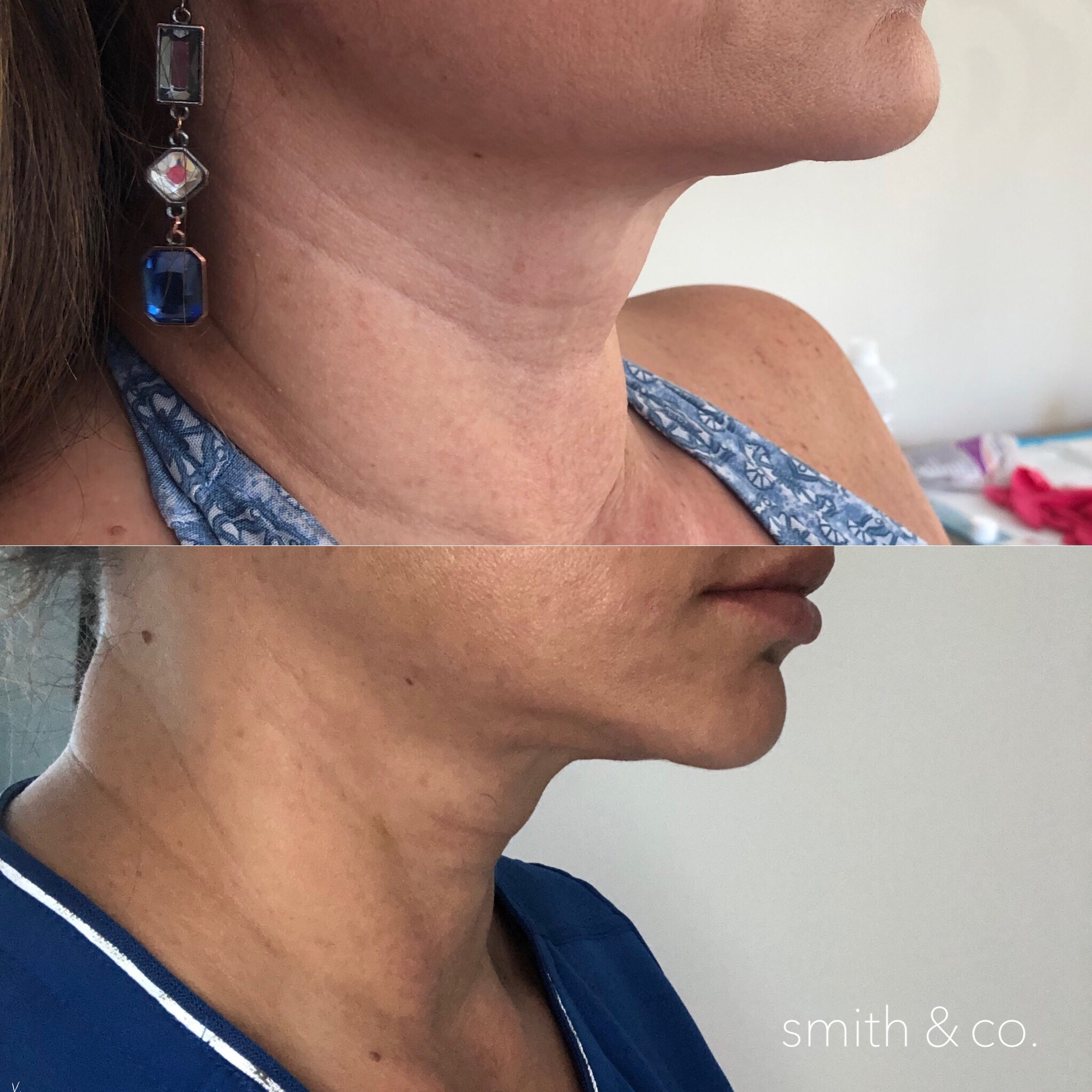 smith & co best lip injections in miami best botox specialist neck bands.PNG