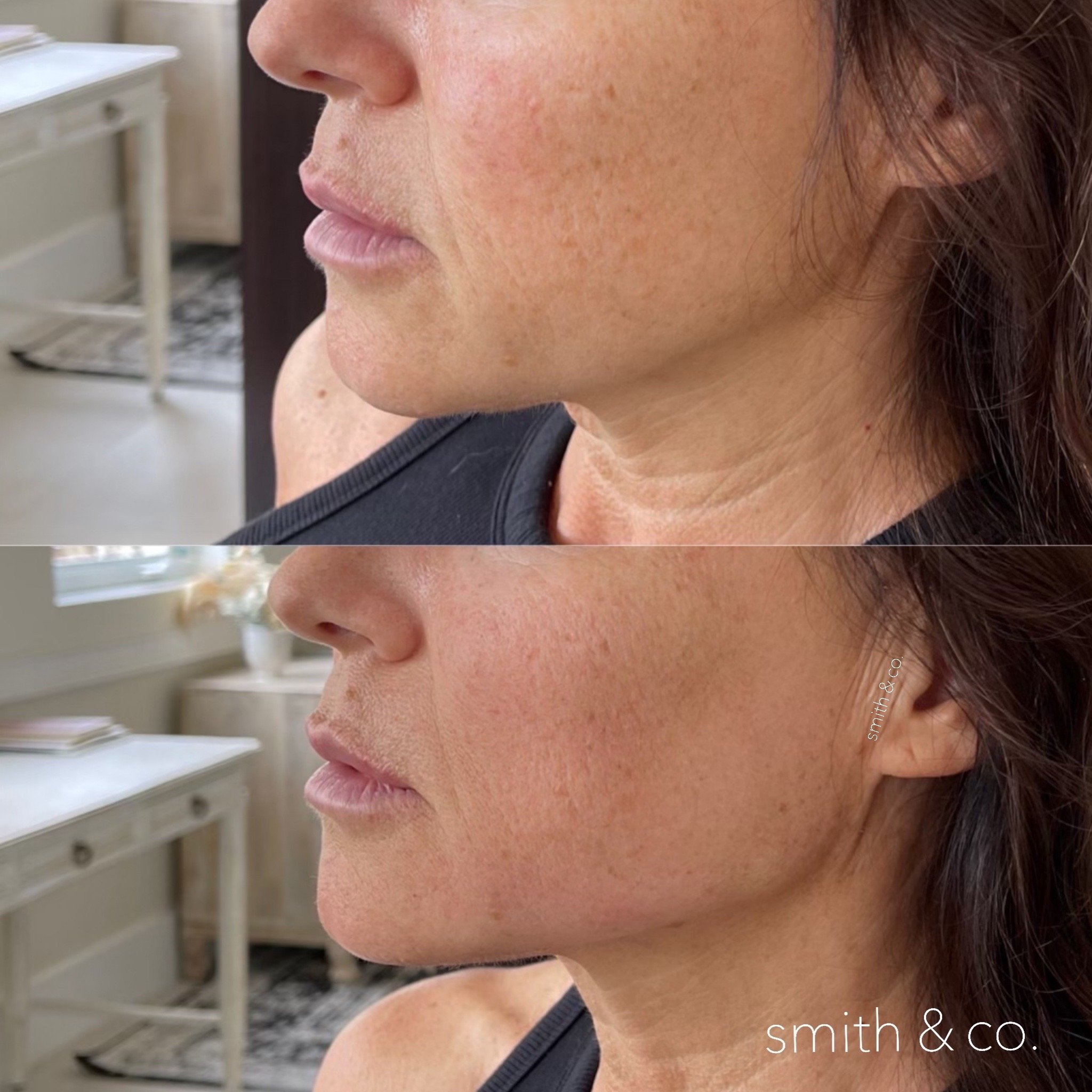 smith & co best lip fillers and PDO threads in miami, ashton technique, russian technique_1246.JPG