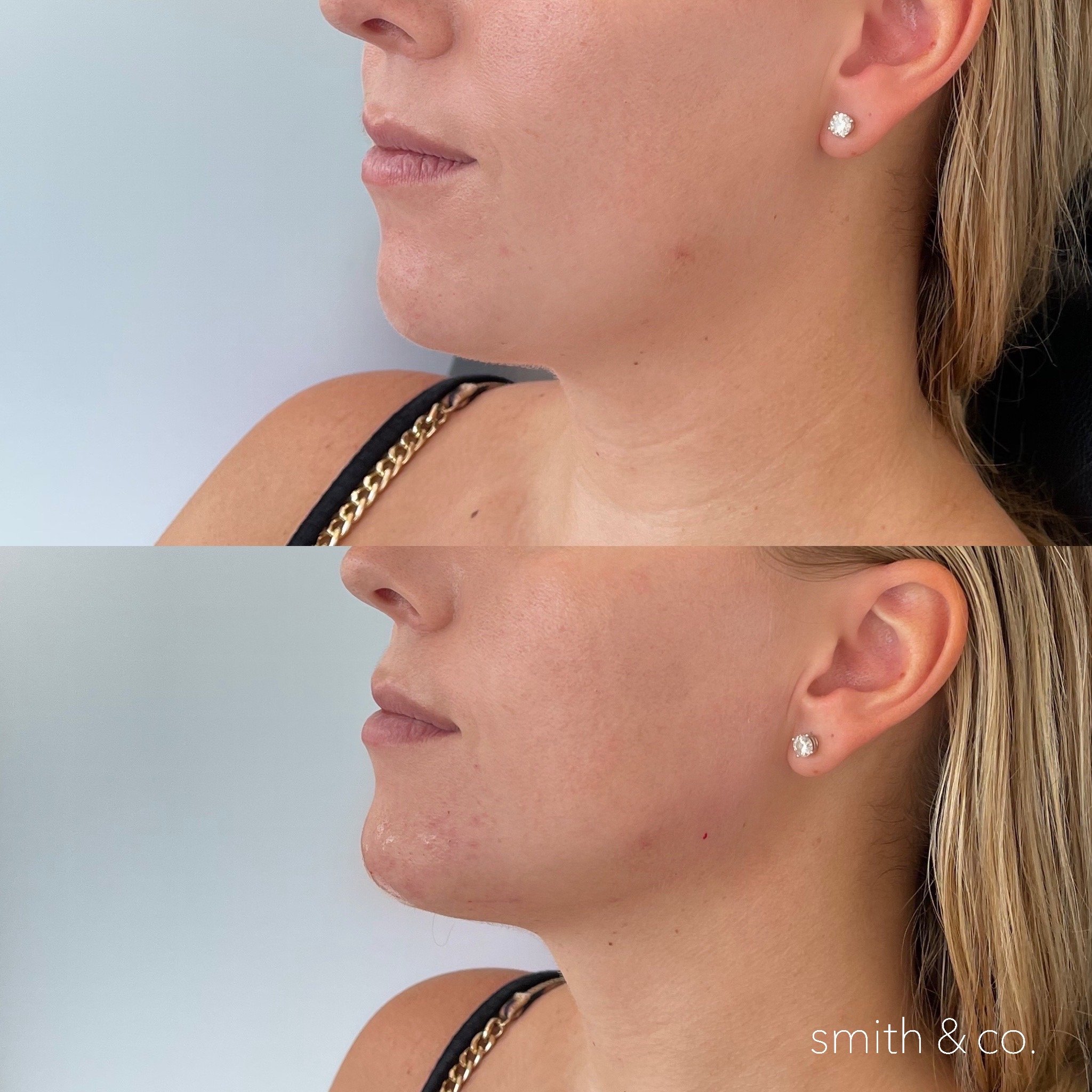 smith & co best lip fillers and PDO threads in miami, ashton technique, russian technique_3871.JPG