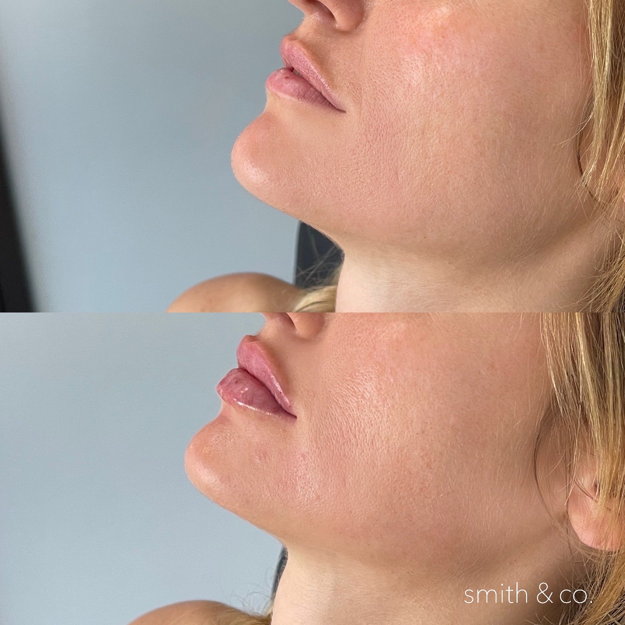 smith & co best lip fillers and PDO threads in miami, ashton technique, russian technique_3891.JPG