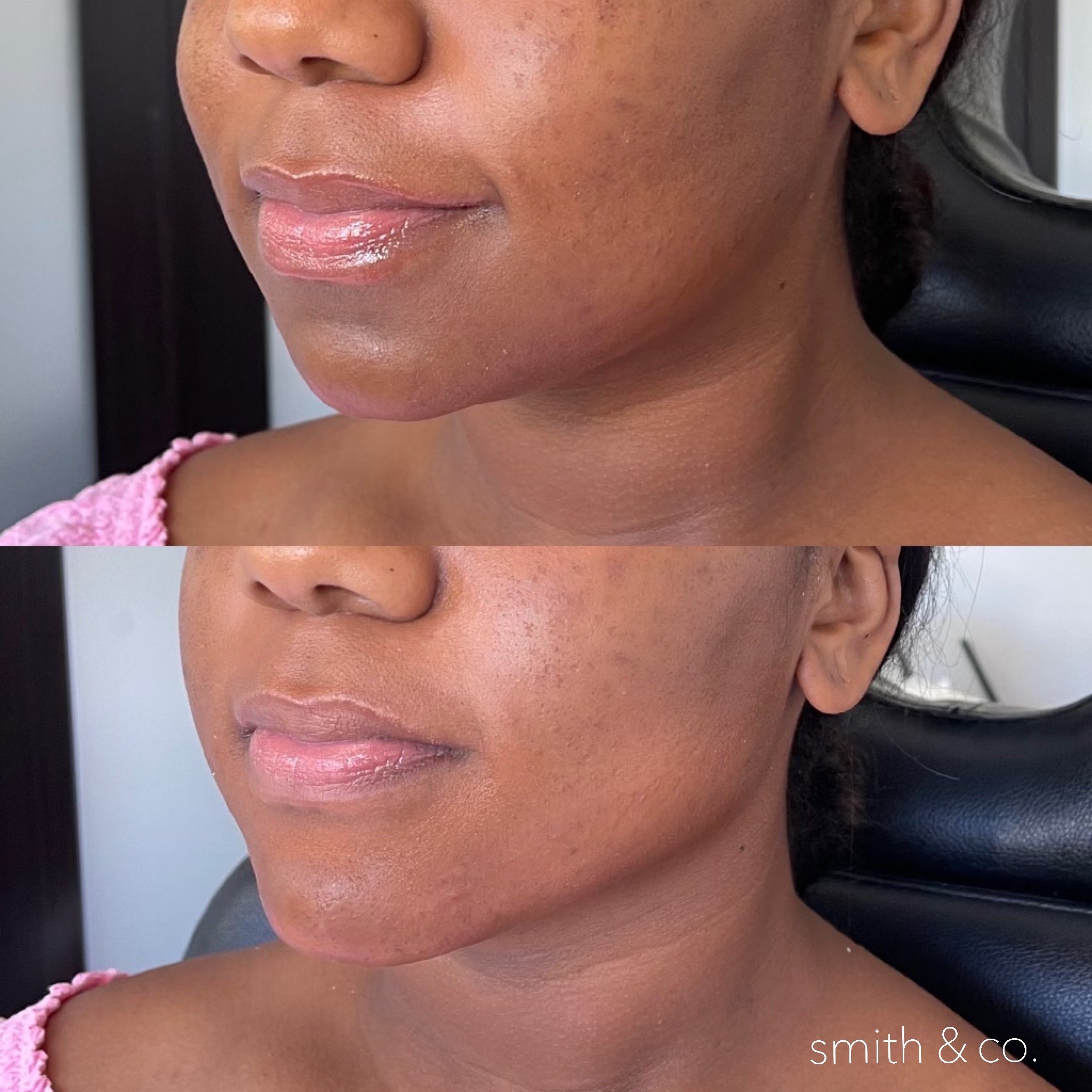 smith & co best lip fillers and PDO threads in miami, ashton technique, russian technique_4366.JPG