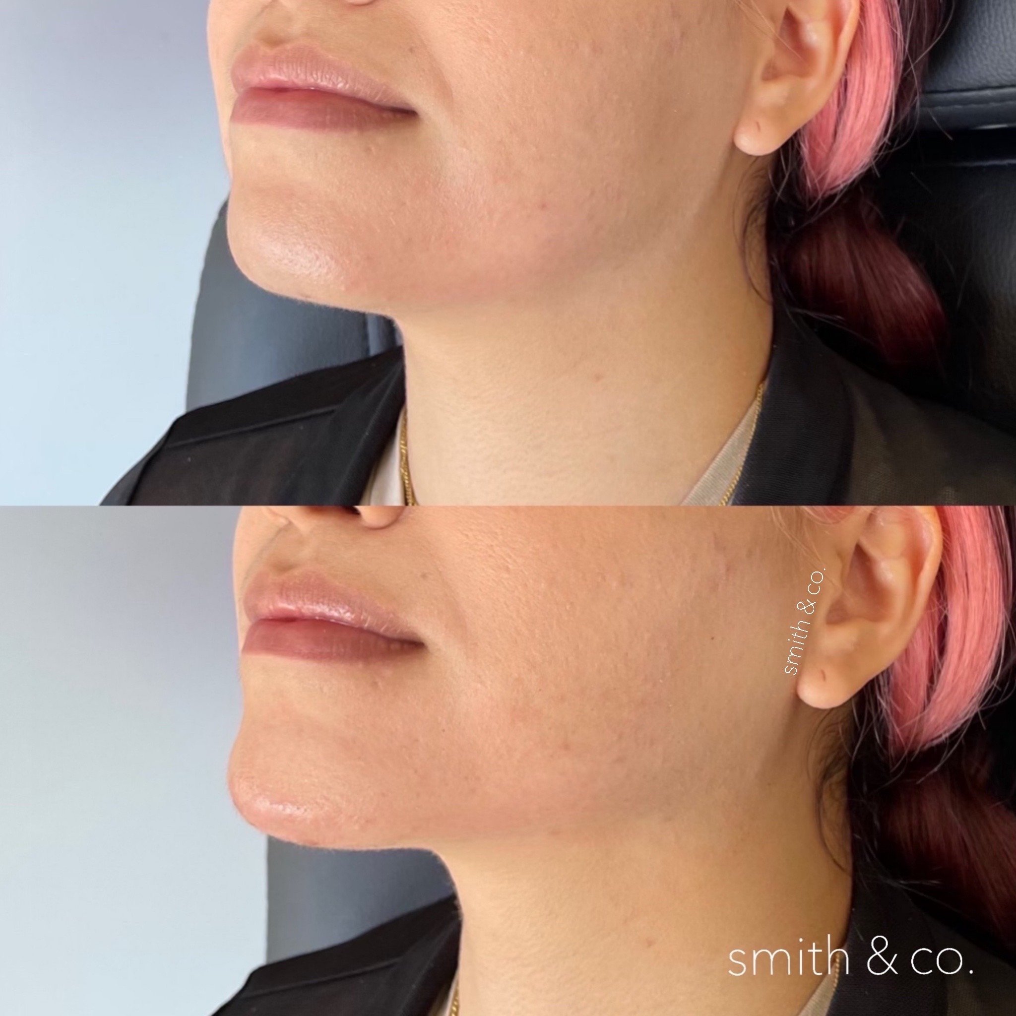 smith & co best lip fillers and PDO threads in miami, ashton technique, russian technique_6601.JPG