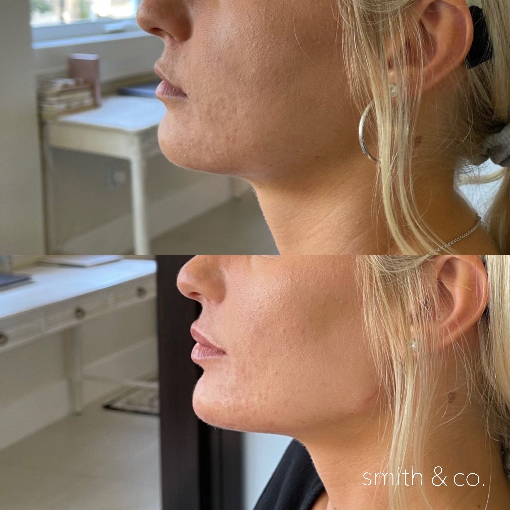 smith & co best lip fillers and PDO threads in miami, ashton technique, russian technique_9846.JPG