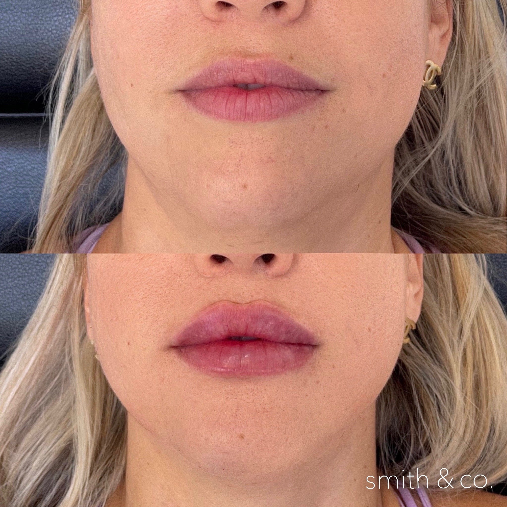 smith & co best lip fillers and PDO threads in miami, ashton technique, russian technique_6588.JPG