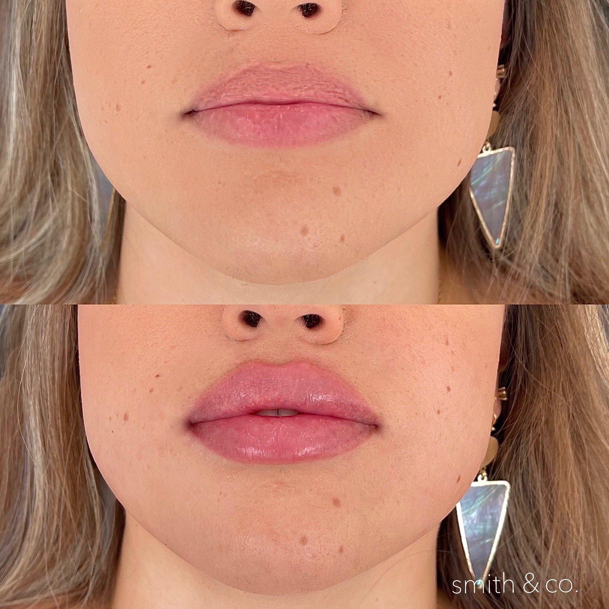 smith & co best lip fillers and PDO threads in miami, ashton technique, russian technique_4950.JPG