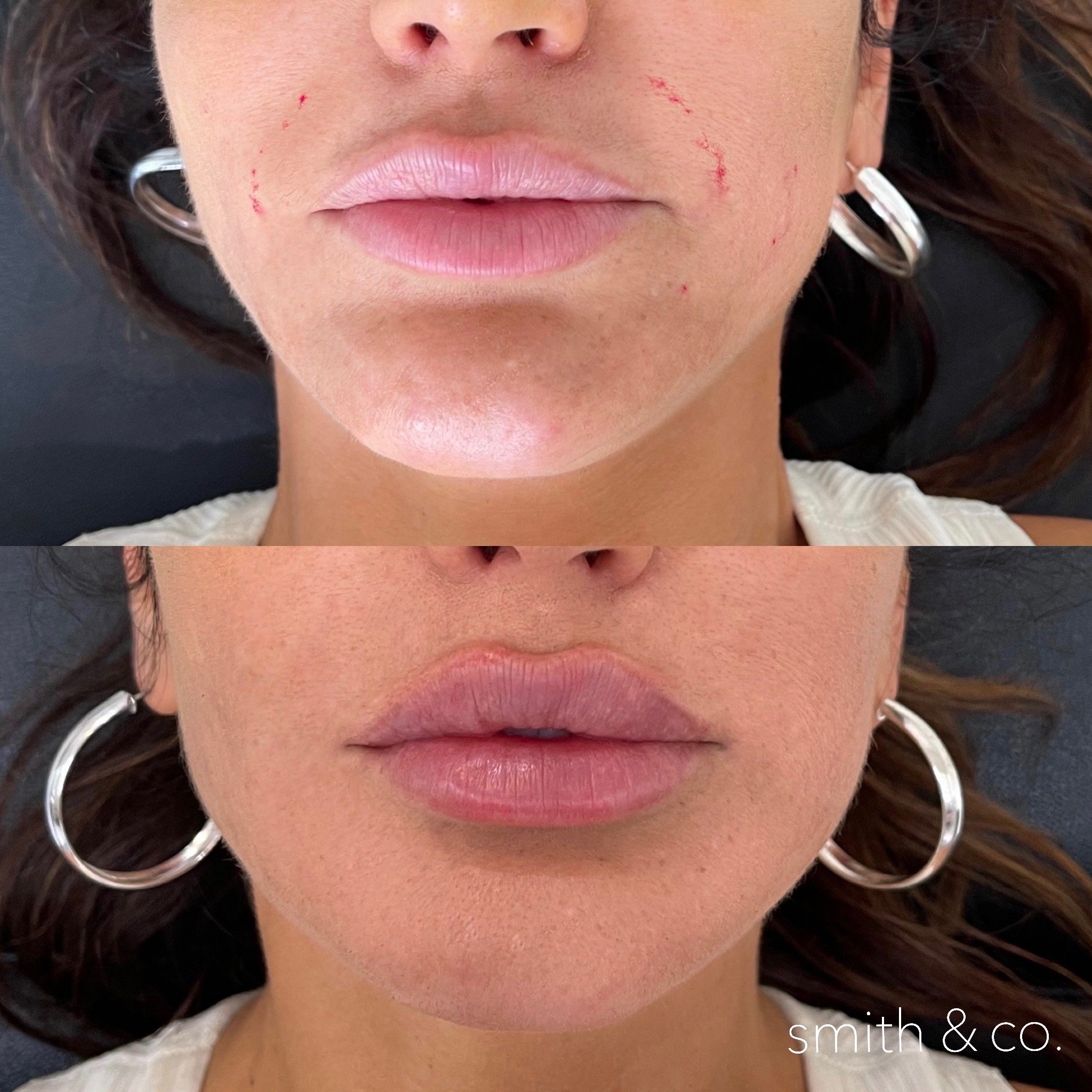 smith & co best lip fillers and PDO threads in miami, ashton technique, russian technique_6558.JPG