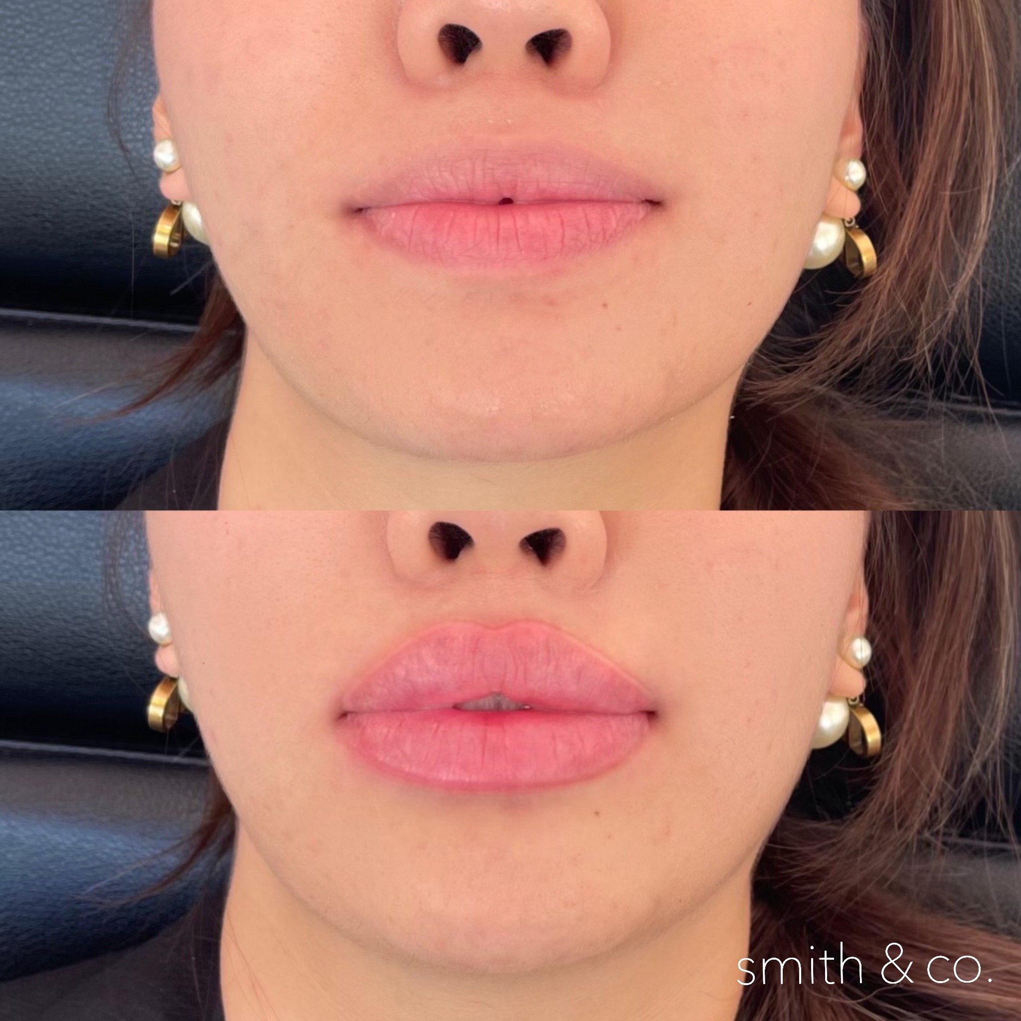 smith & co best lip fillers and PDO threads in miami, ashton technique, russian technique_8730.JPG