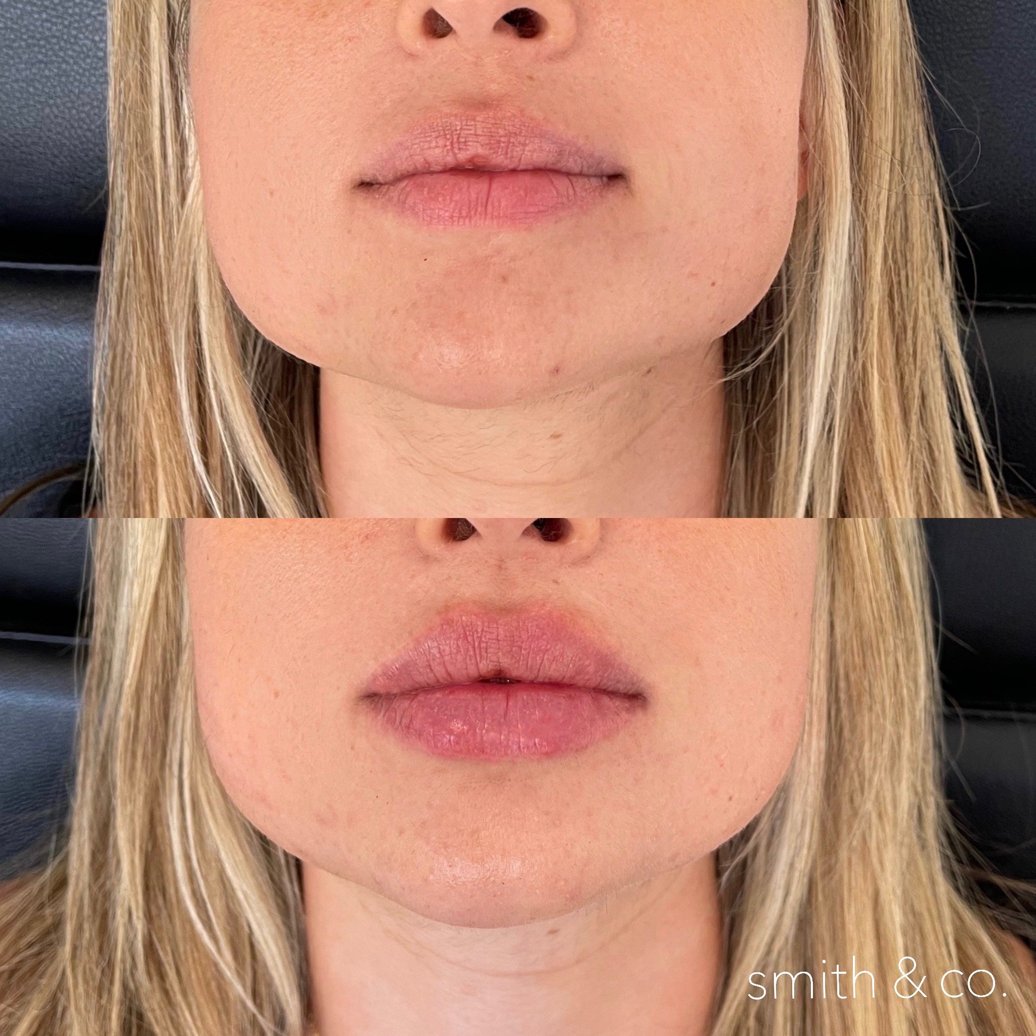 smith & co best lip fillers and PDO threads in miami, ashton technique, russian technique_6549.JPG