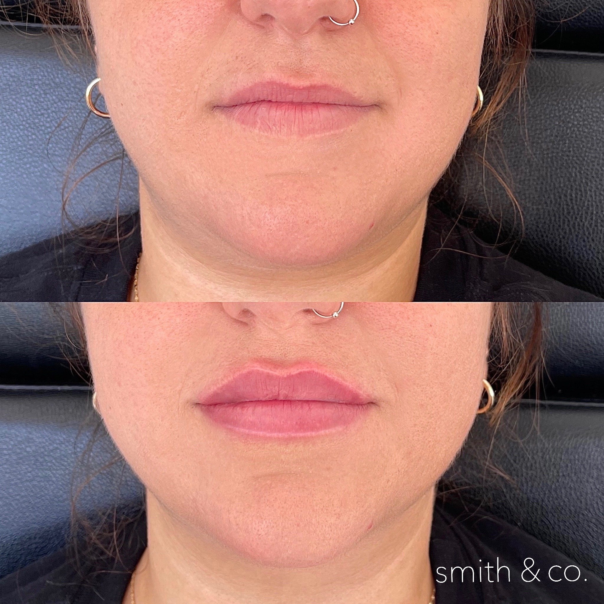 smith & co best lip fillers and PDO threads in miami, ashton technique, russian technique_6564.JPG