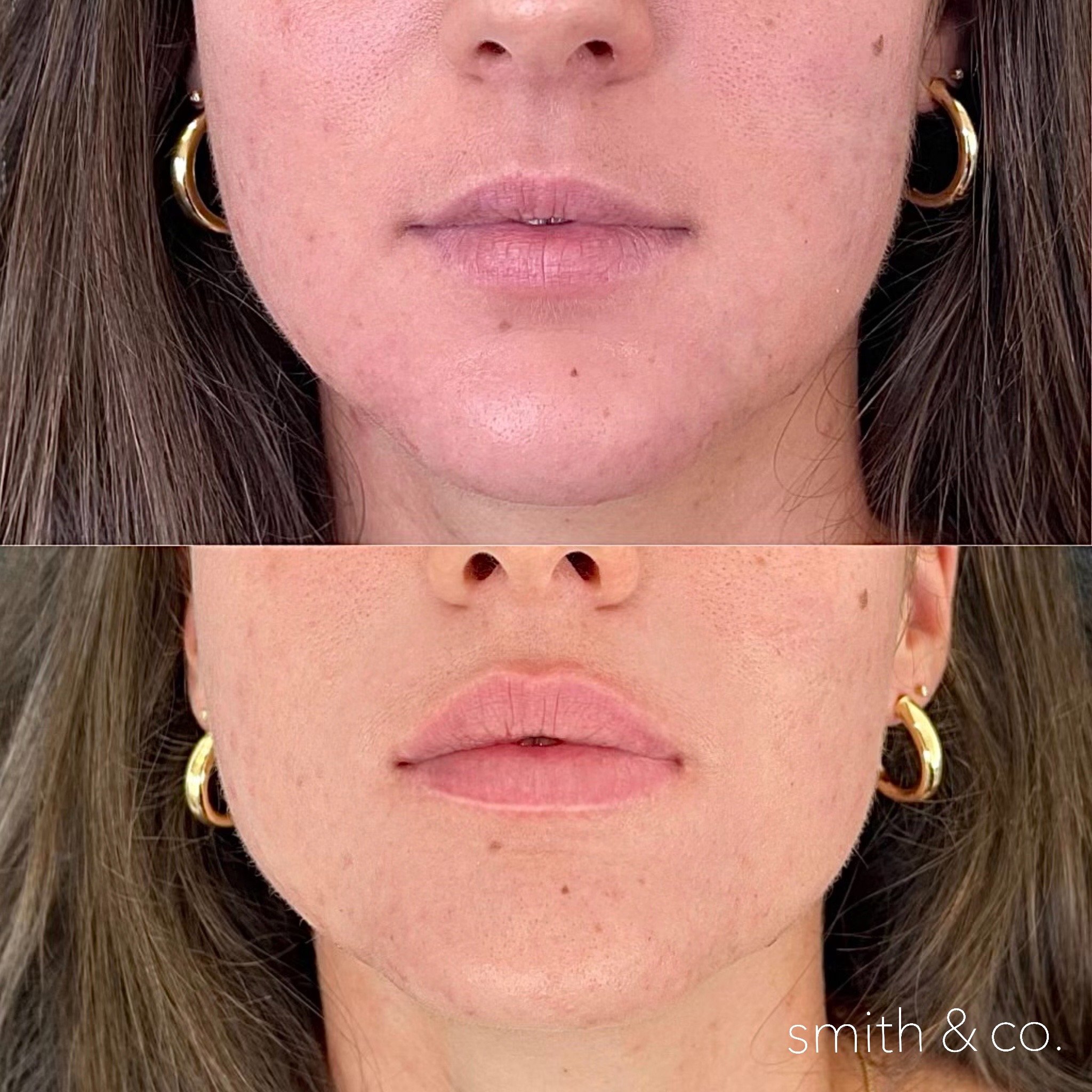 smith & co best lip fillers and PDO threads in miami, ashton technique, russian technique_8745.JPG