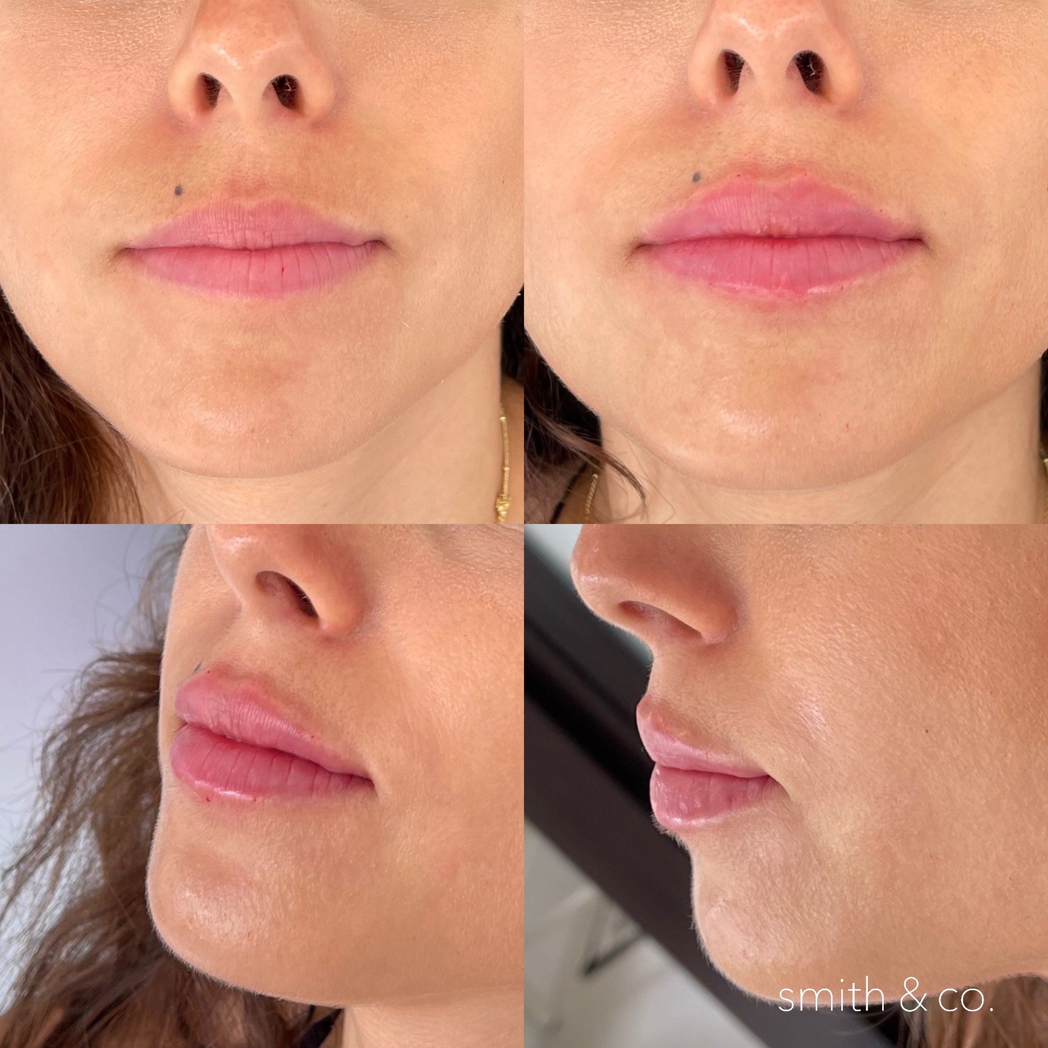 side profile lipssmith & co best lip fillers and PDO threads in miami, ashton technique, russian technique_3936.JPG