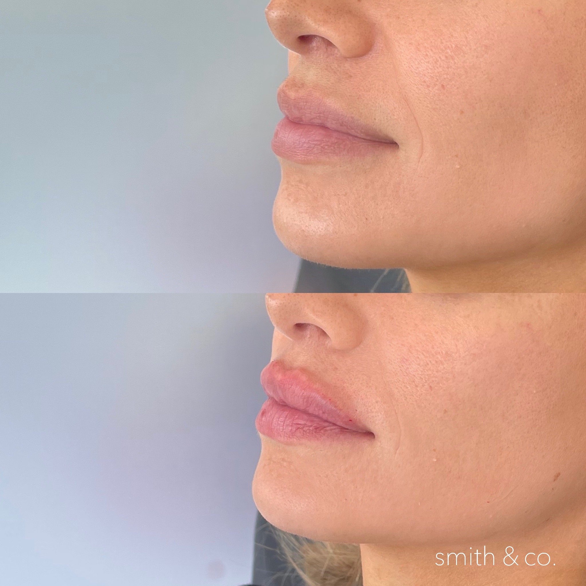 smith & co best lip fillers and PDO threads in miami, ashton technique, russian technique_3923.JPG