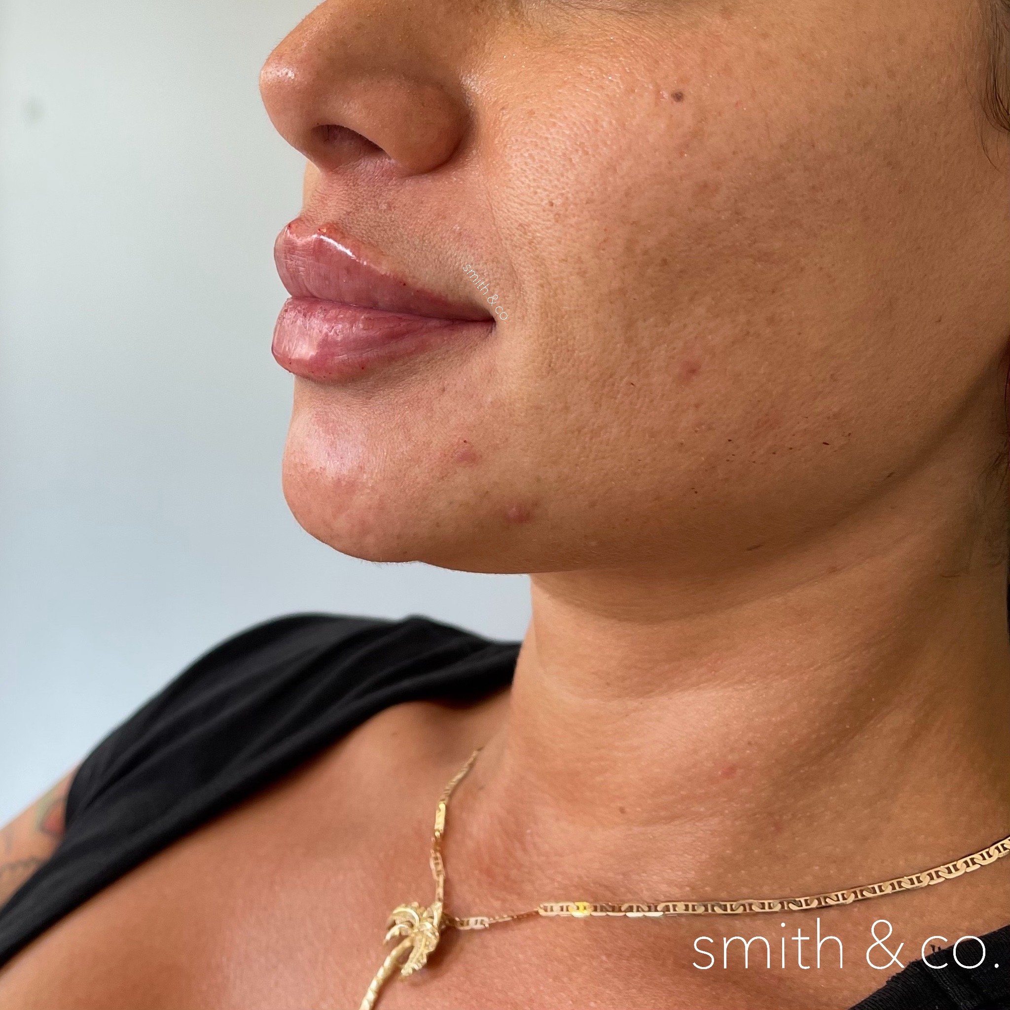 smith & co best lip fillers and PDO threads in miami, ashton technique, russian technique_4331.JPG